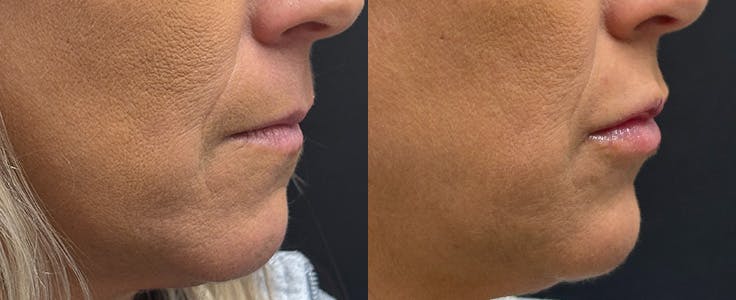 Hyaluronic Acid Injections Before & After Gallery - Patient 405718 - Image 2