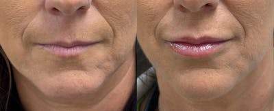 Hyaluronic Acid Injections Before & After Gallery - Patient 405718 - Image 1