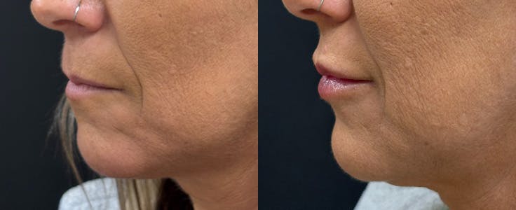 Hyaluronic Acid Injections Before & After Gallery - Patient 405718 - Image 3