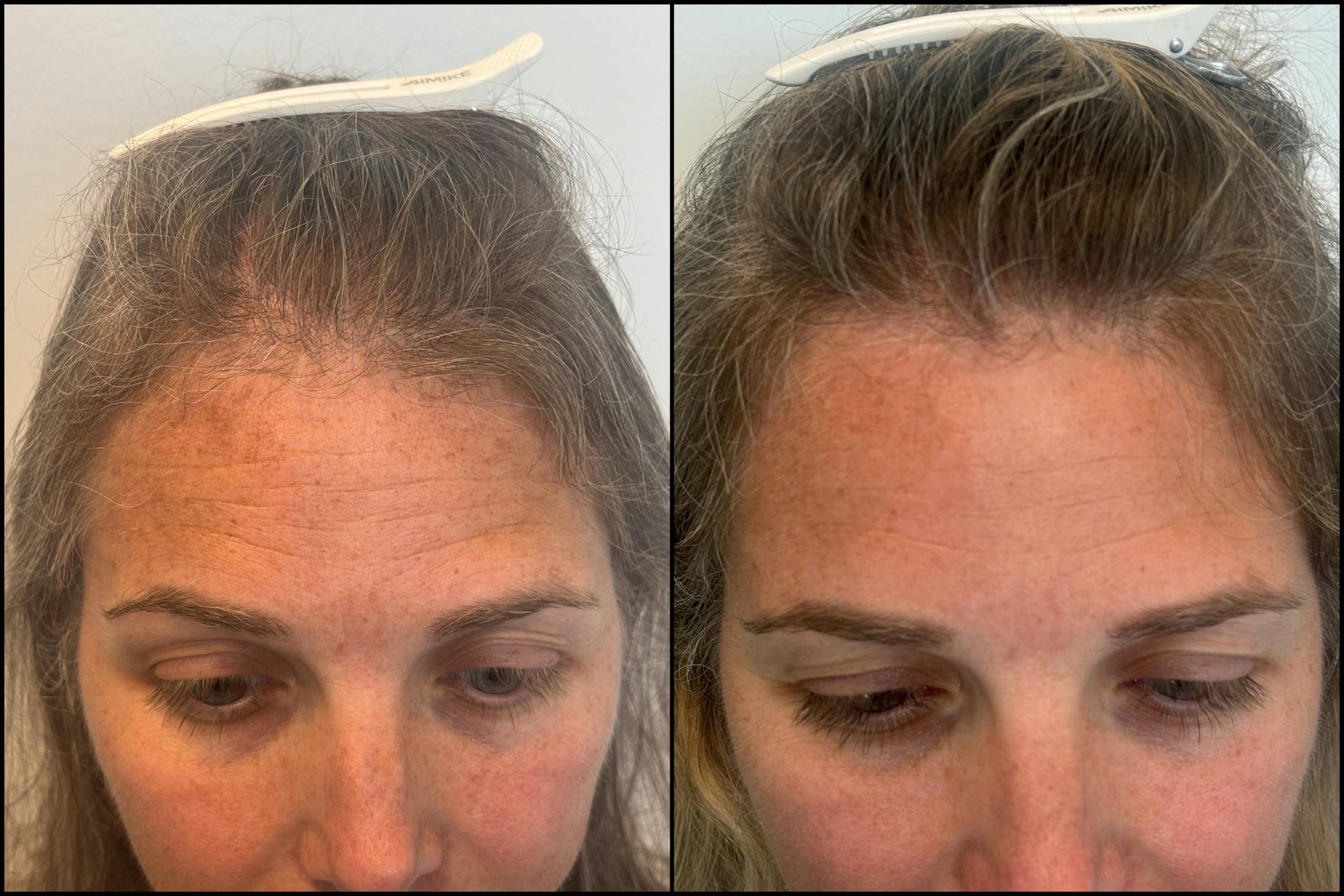 PRP Hair Restoration Before & After Gallery - Patient 418562 - Image 1