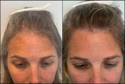 PRP Hair Restoration Before & After Gallery - Patient 418562 - Image 1