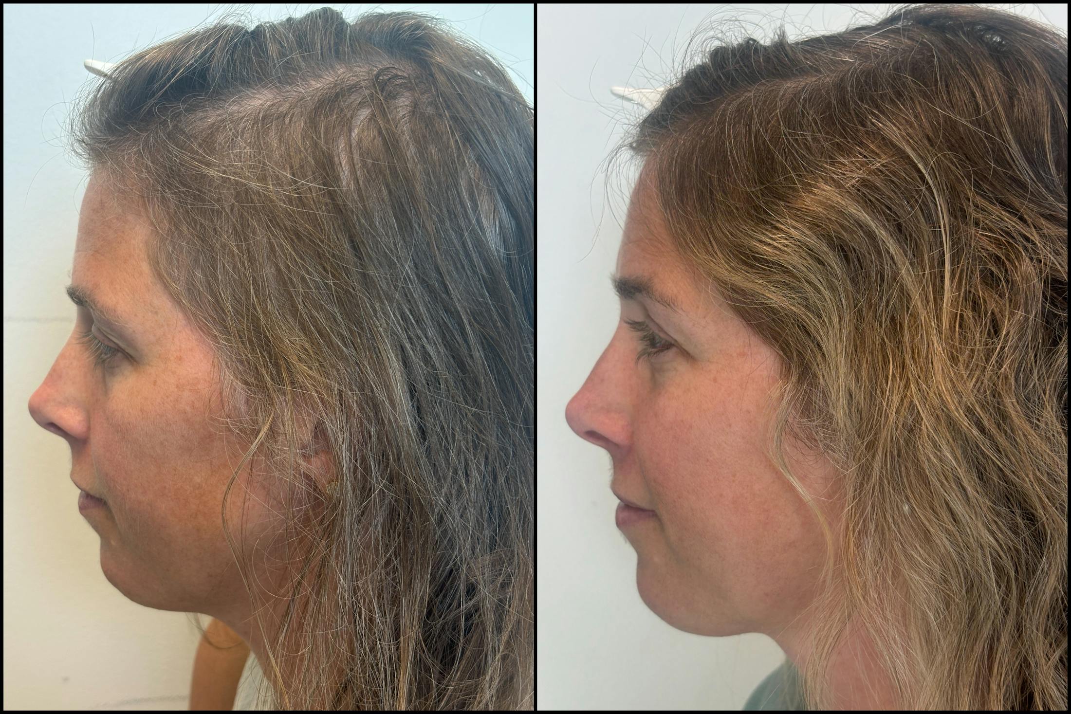 PRP Hair Restoration Before & After Gallery - Patient 418562 - Image 4