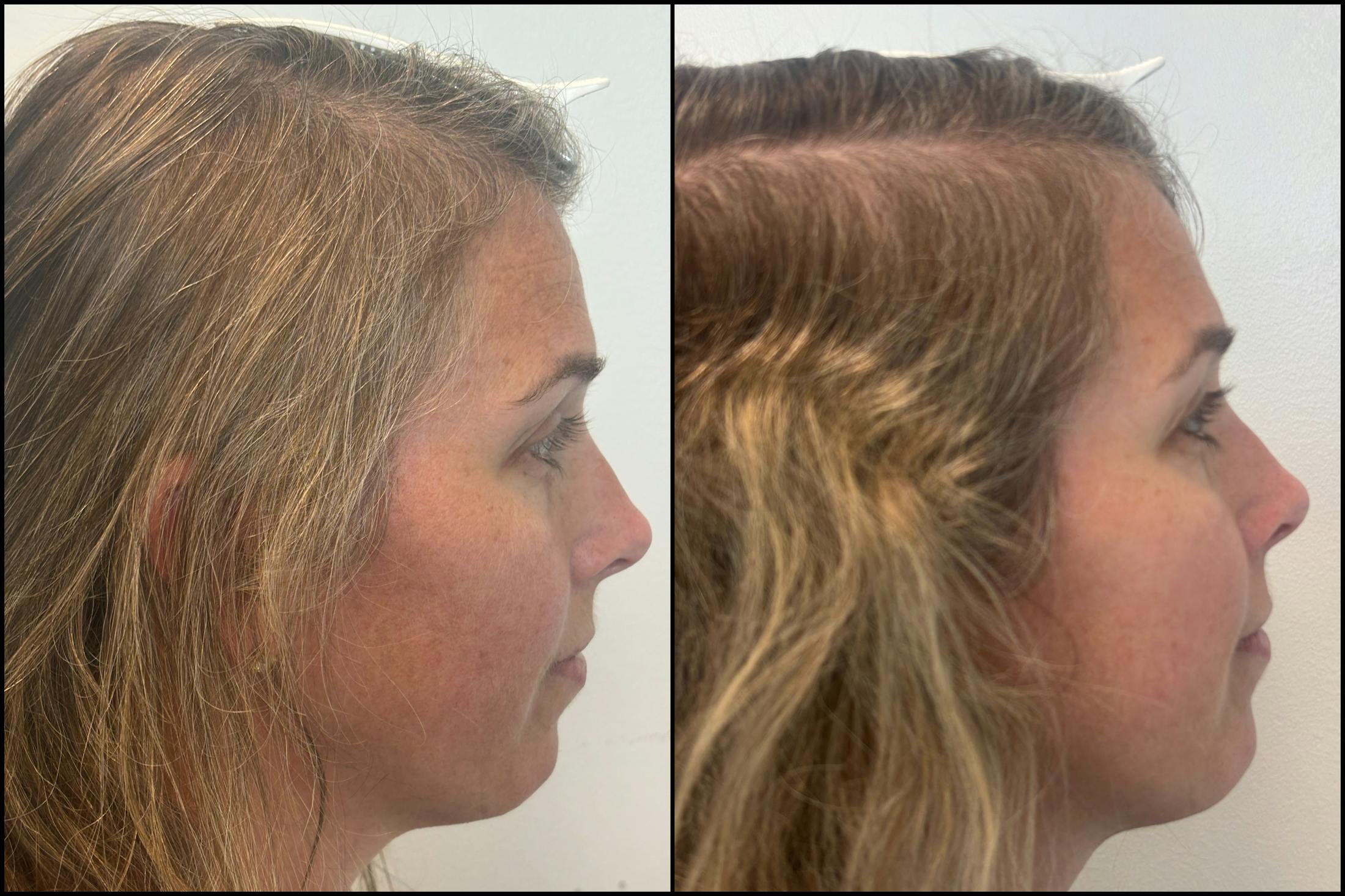PRP Hair Restoration Before & After Gallery - Patient 418562 - Image 2