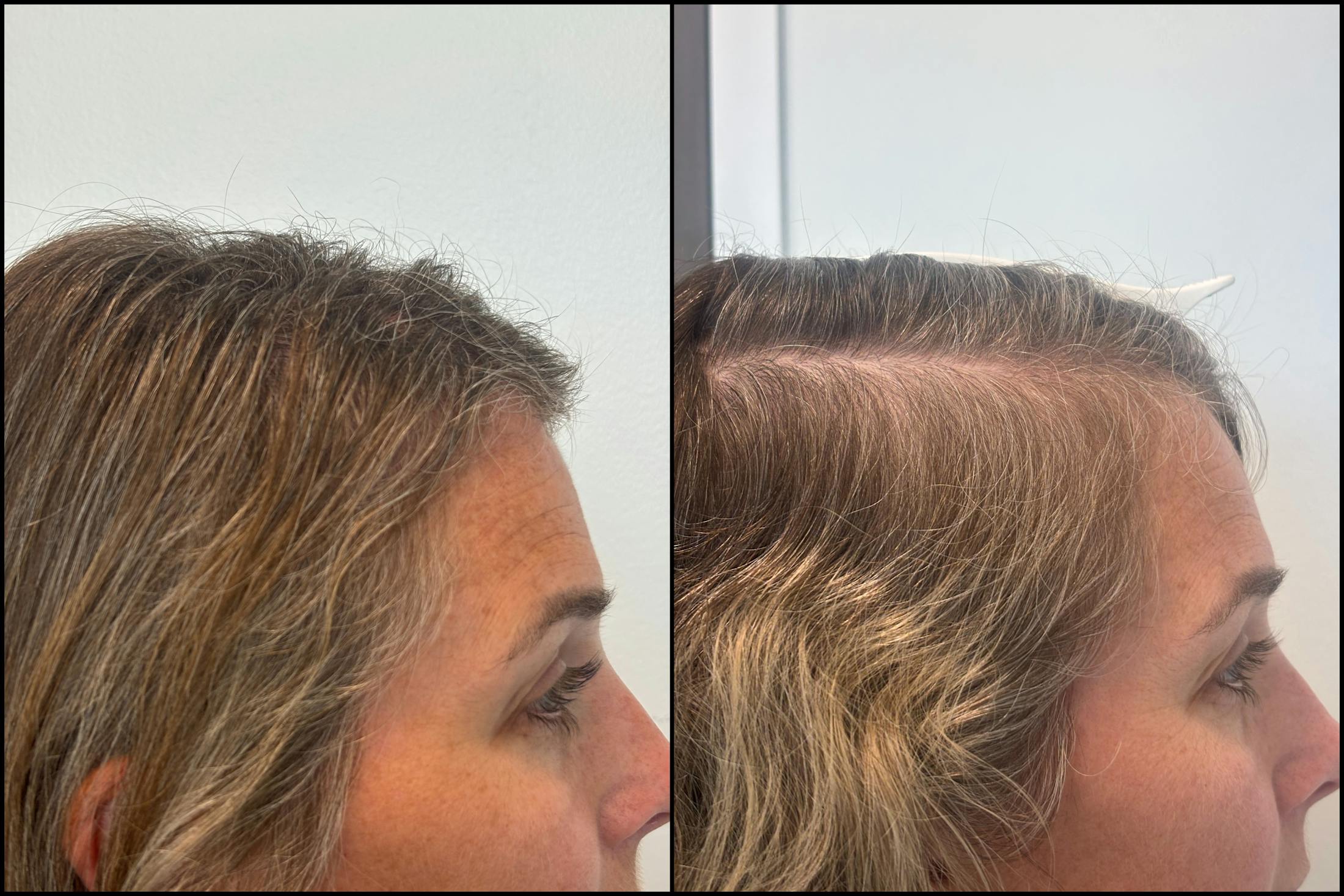 PRP Hair Restoration Before & After Gallery - Patient 418562 - Image 3