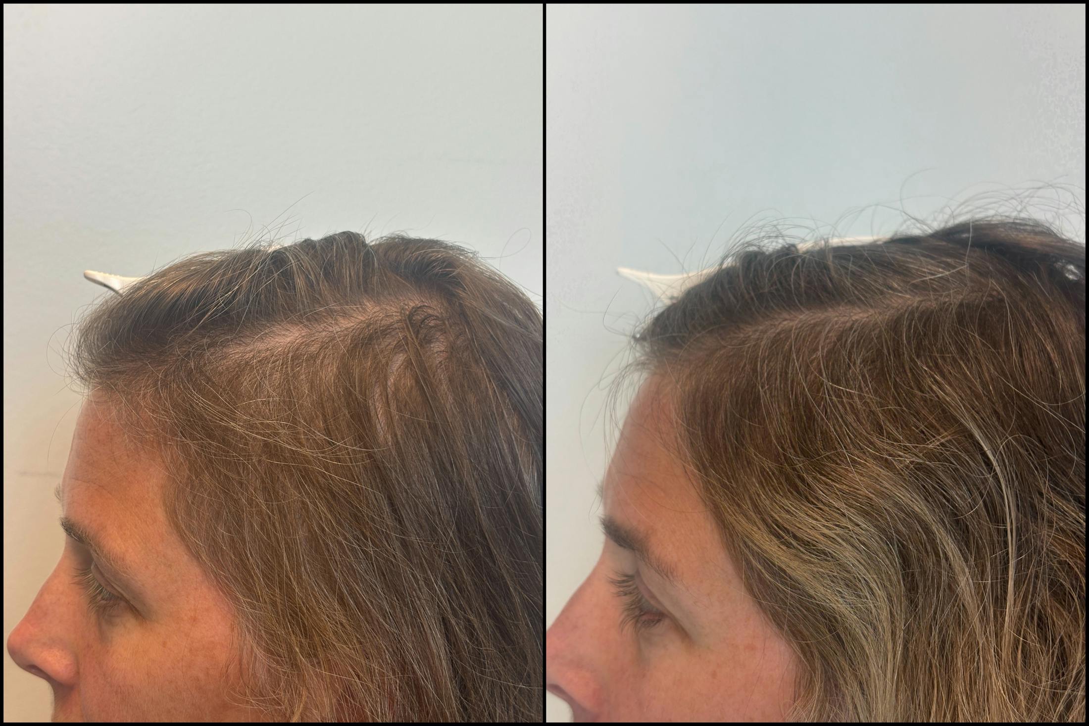 PRP Hair Restoration Before & After Gallery - Patient 418562 - Image 5