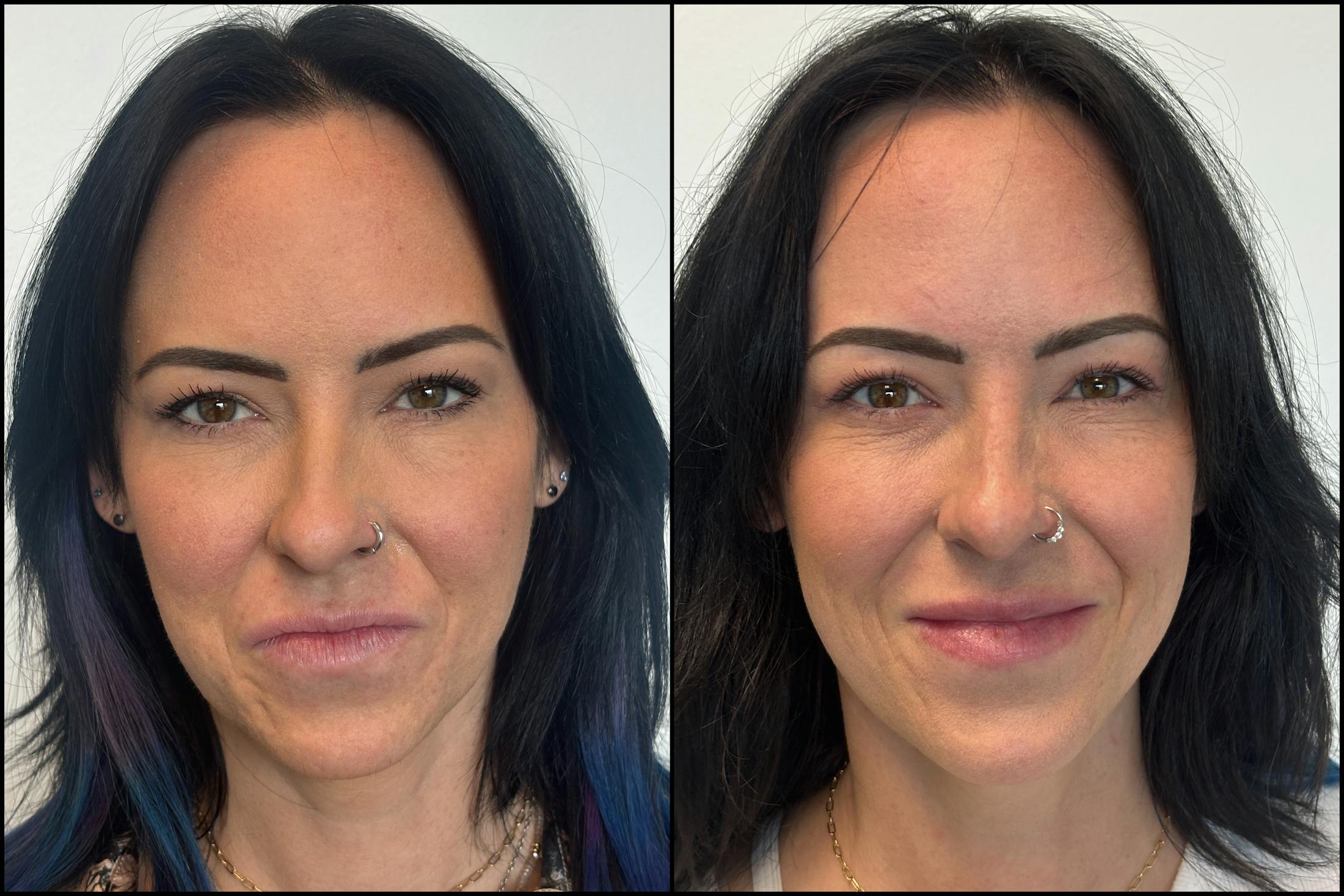 BOTOX/Dysport Before & After Gallery - Patient 193393 - Image 1