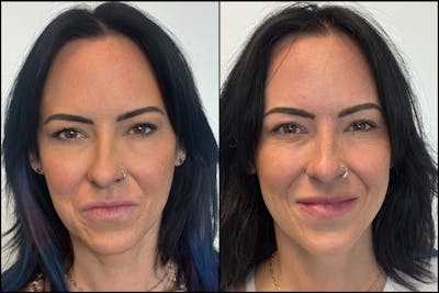 BOTOX/Dysport Before & After Gallery - Patient 193393 - Image 1