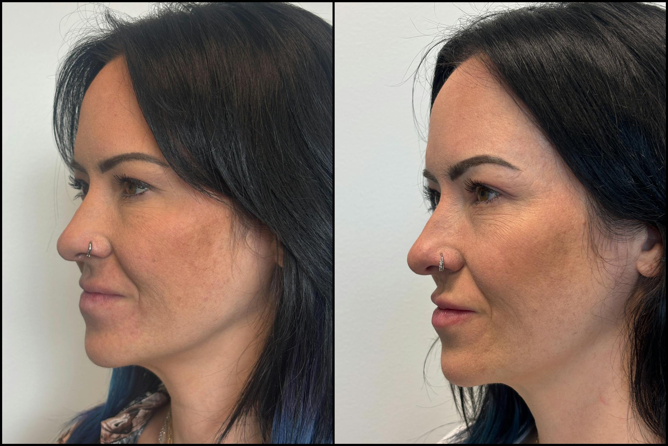 BOTOX/Dysport Before & After Gallery - Patient 193393 - Image 3