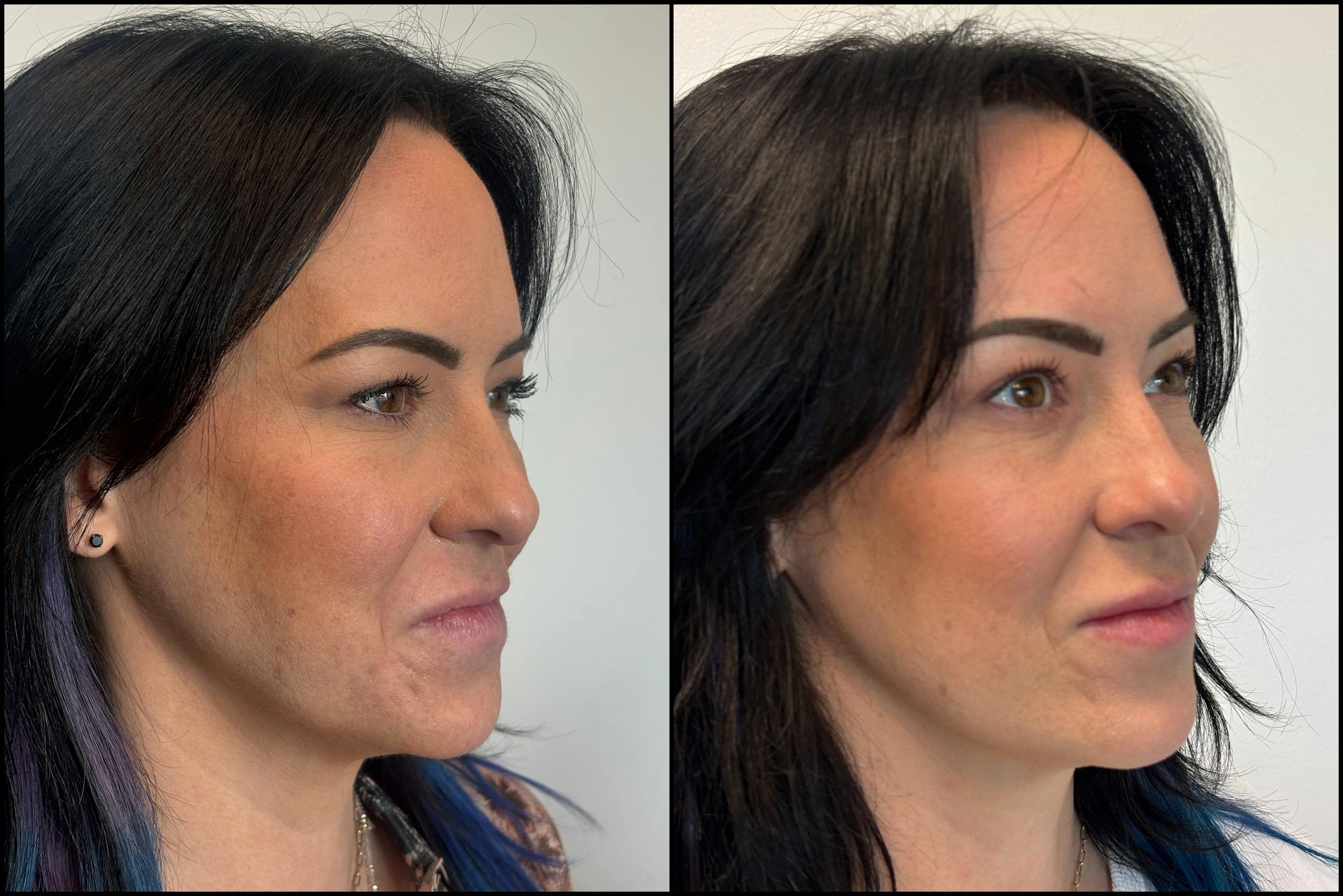 BOTOX/Dysport Before & After Gallery - Patient 193393 - Image 2