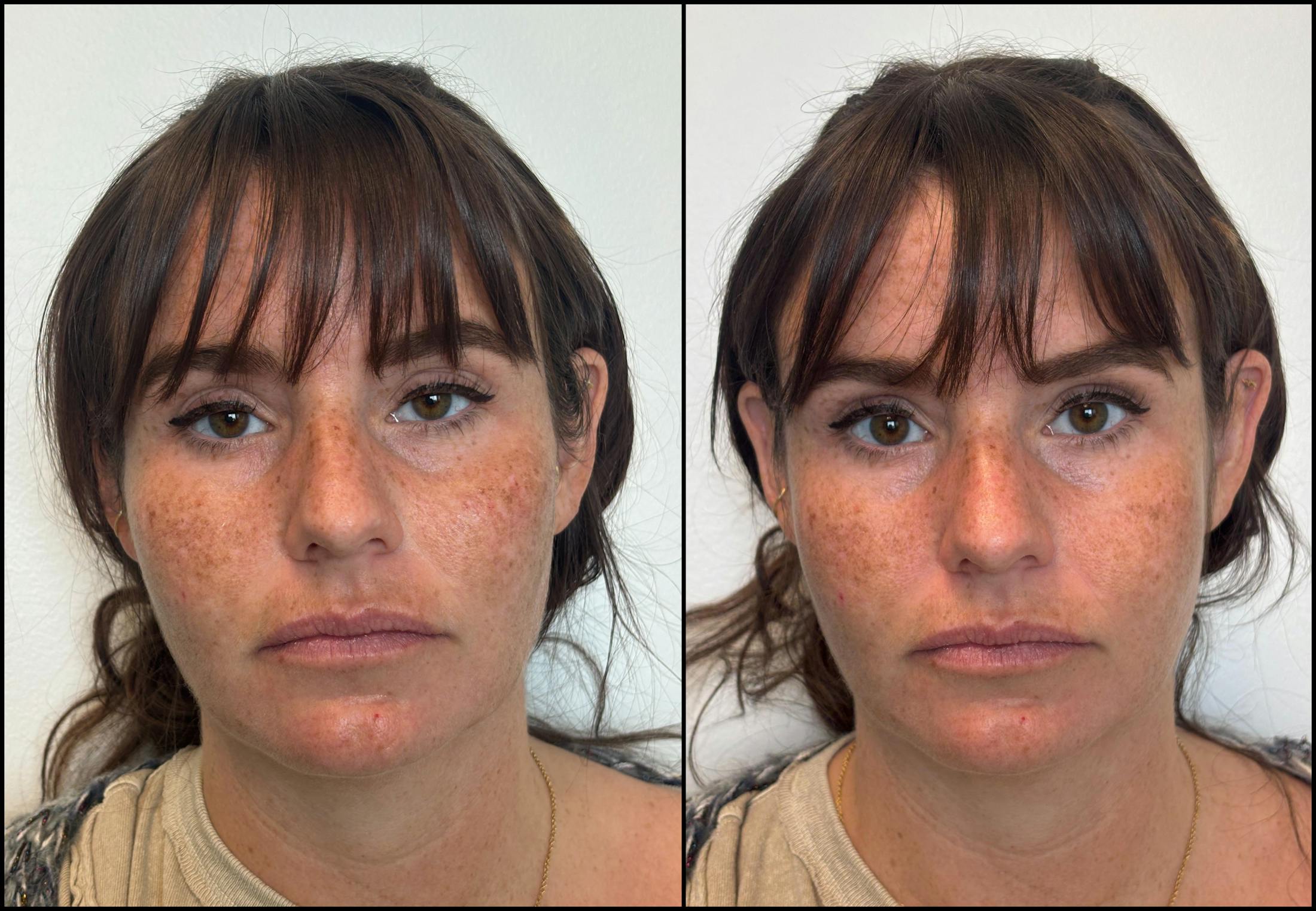 Hyaluronic Acid Injections Before & After Gallery - Patient 276748 - Image 1