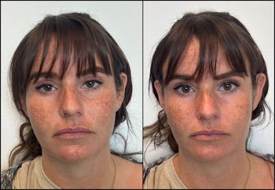 Hyaluronic Acid Injections Before & After Gallery - Patient 276748 - Image 1