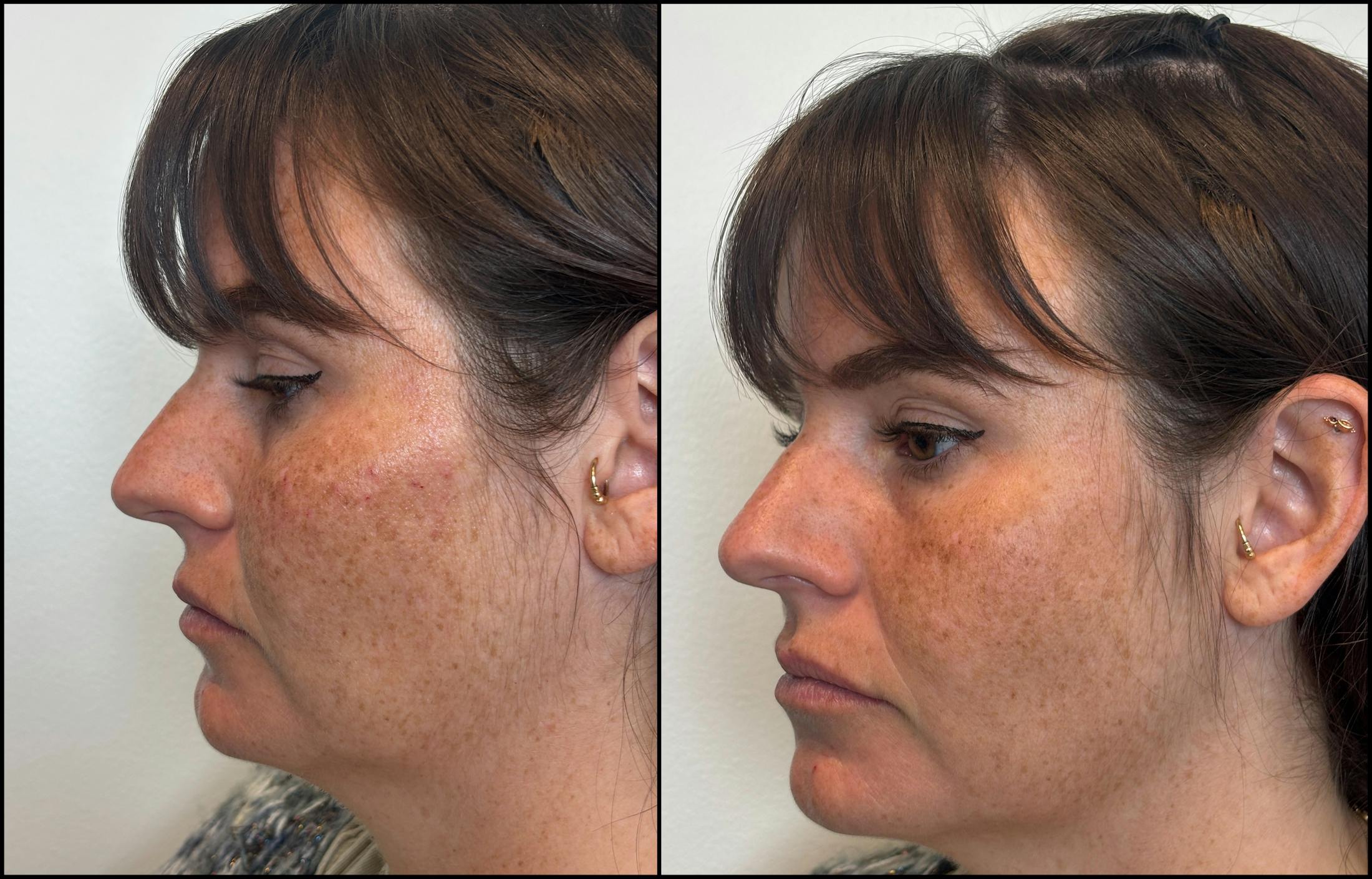 Hyaluronic Acid Injections Before & After Gallery - Patient 276748 - Image 3