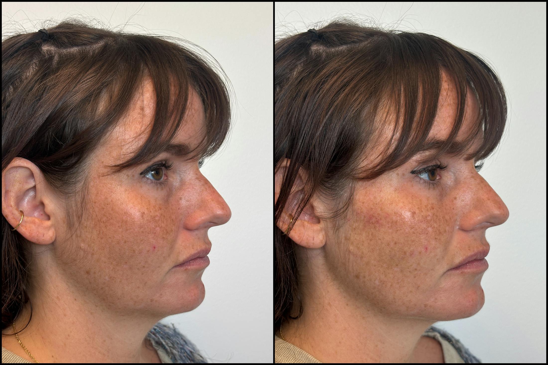 Hyaluronic Acid Injections Before & After Gallery - Patient 276748 - Image 2