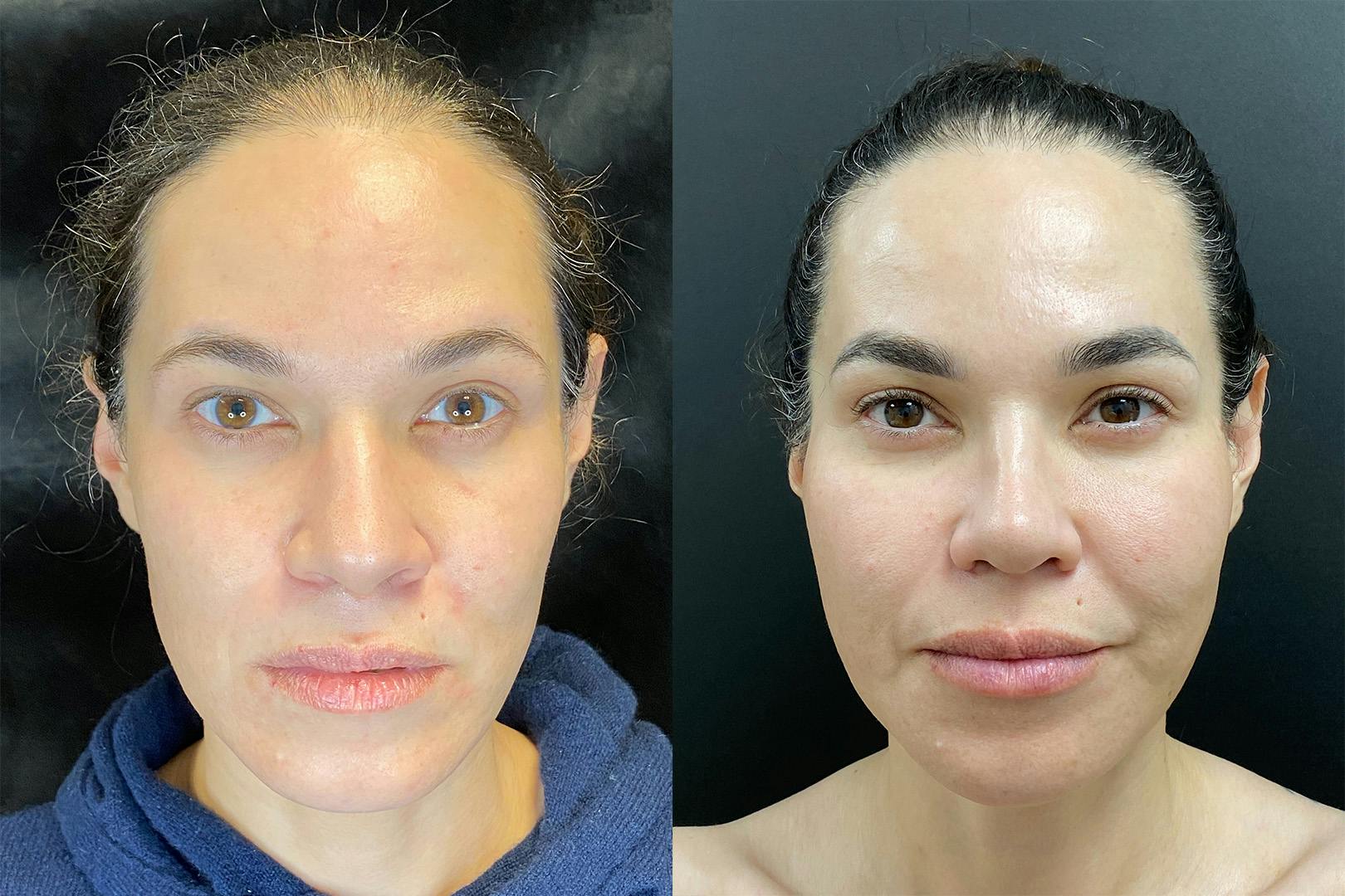Sculptra Before & After Gallery - Patient 205396 - Image 1