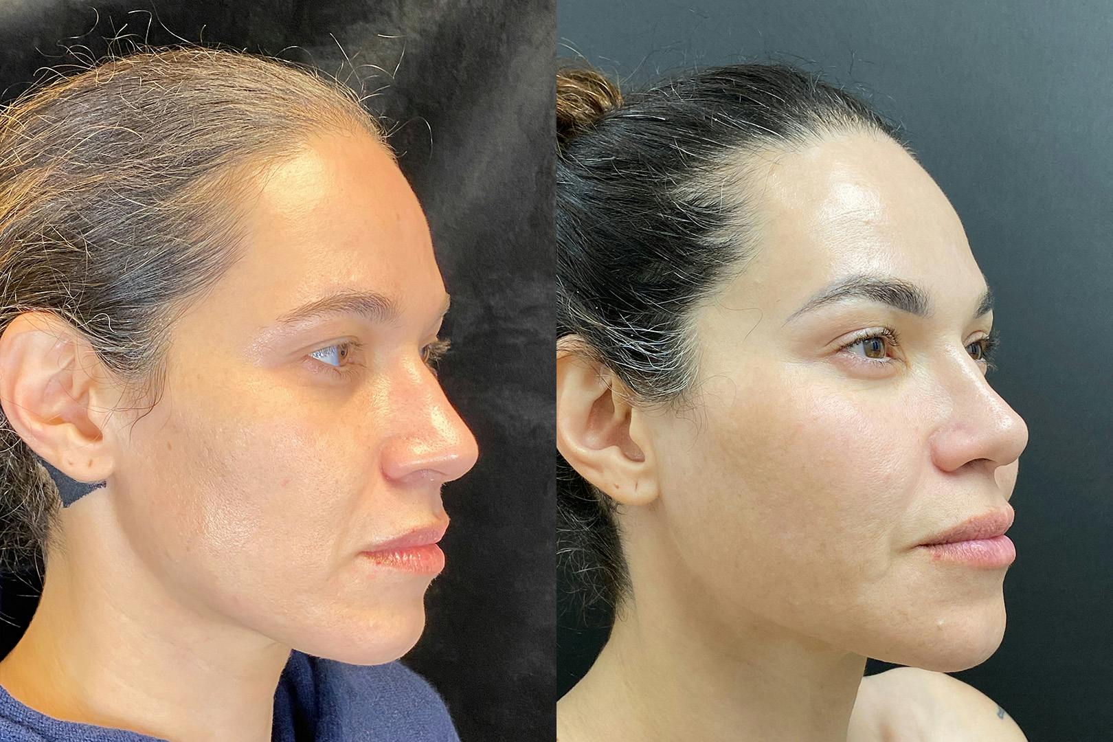 Sculptra Before & After Gallery - Patient 205396 - Image 2