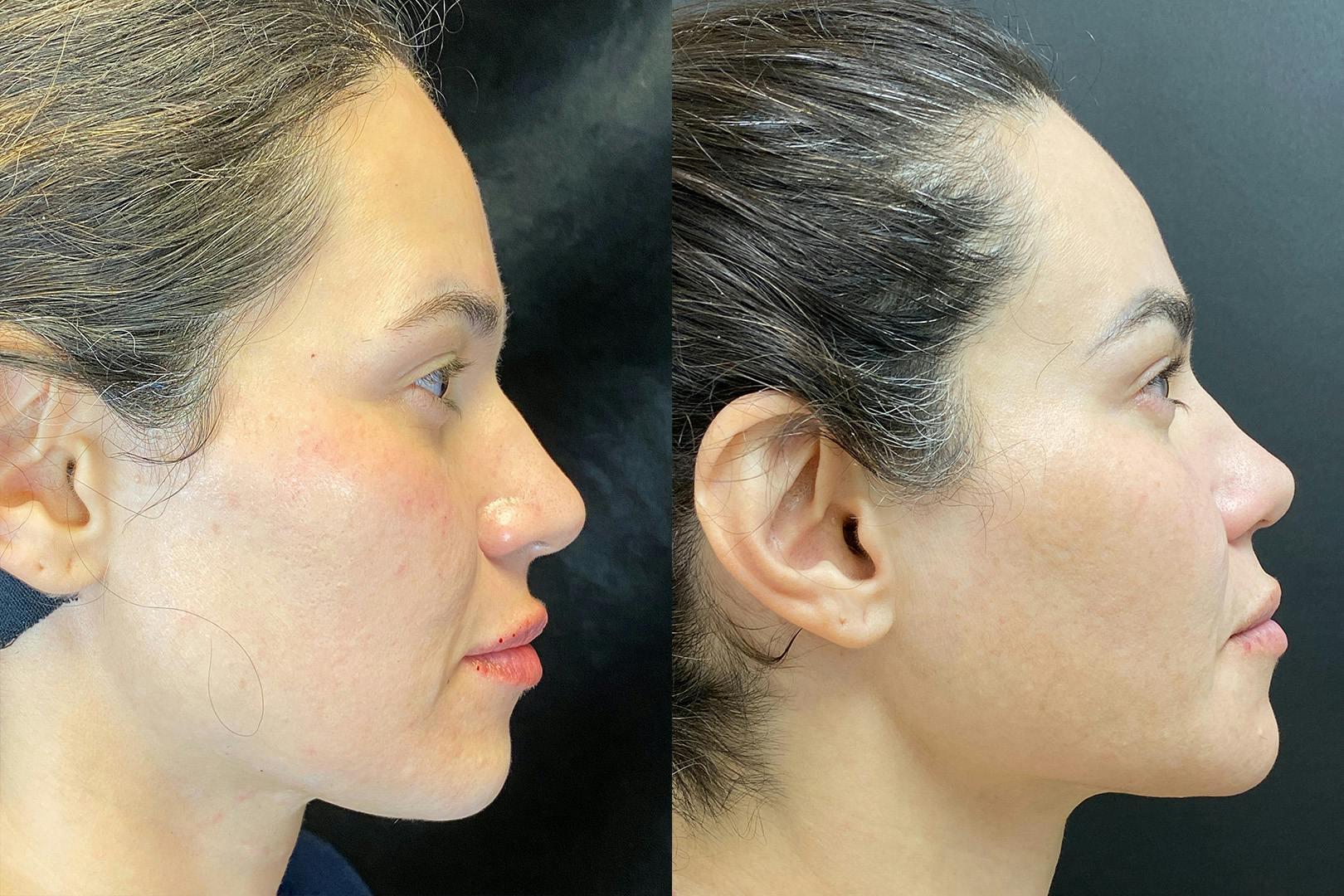 Sculptra Before & After Gallery - Patient 205396 - Image 3