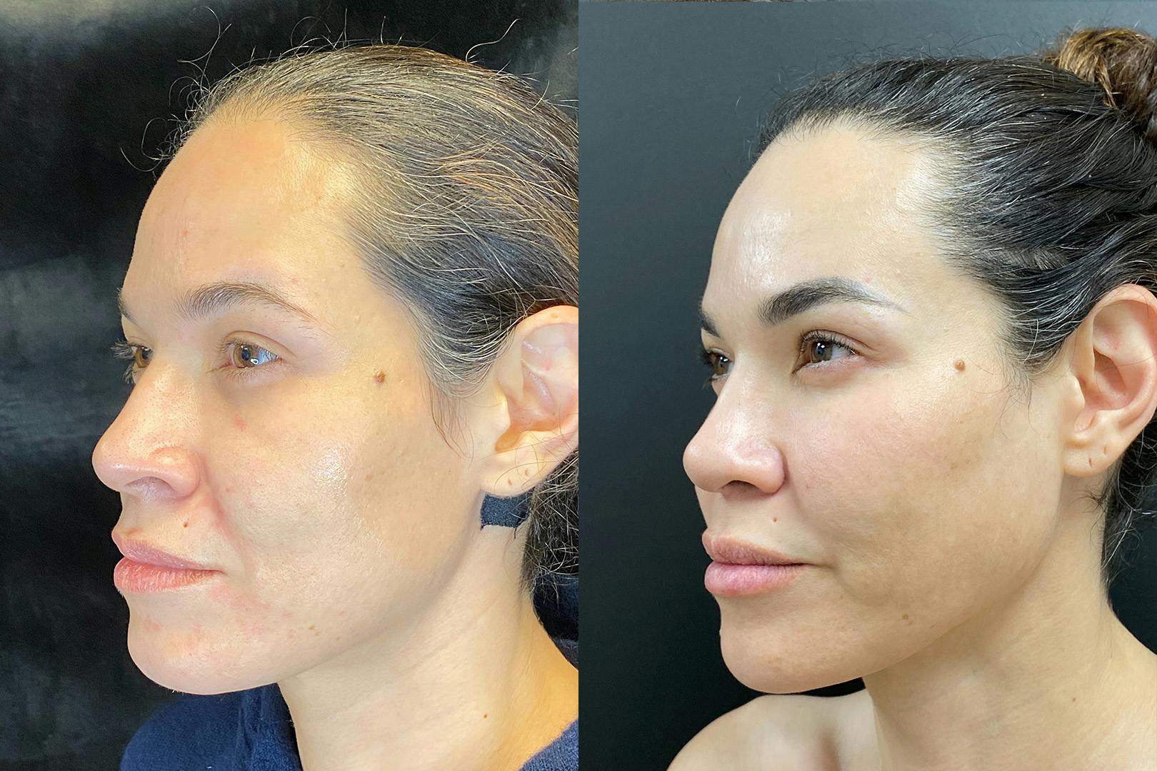 Sculptra Before & After Gallery - Patient 205396 - Image 4