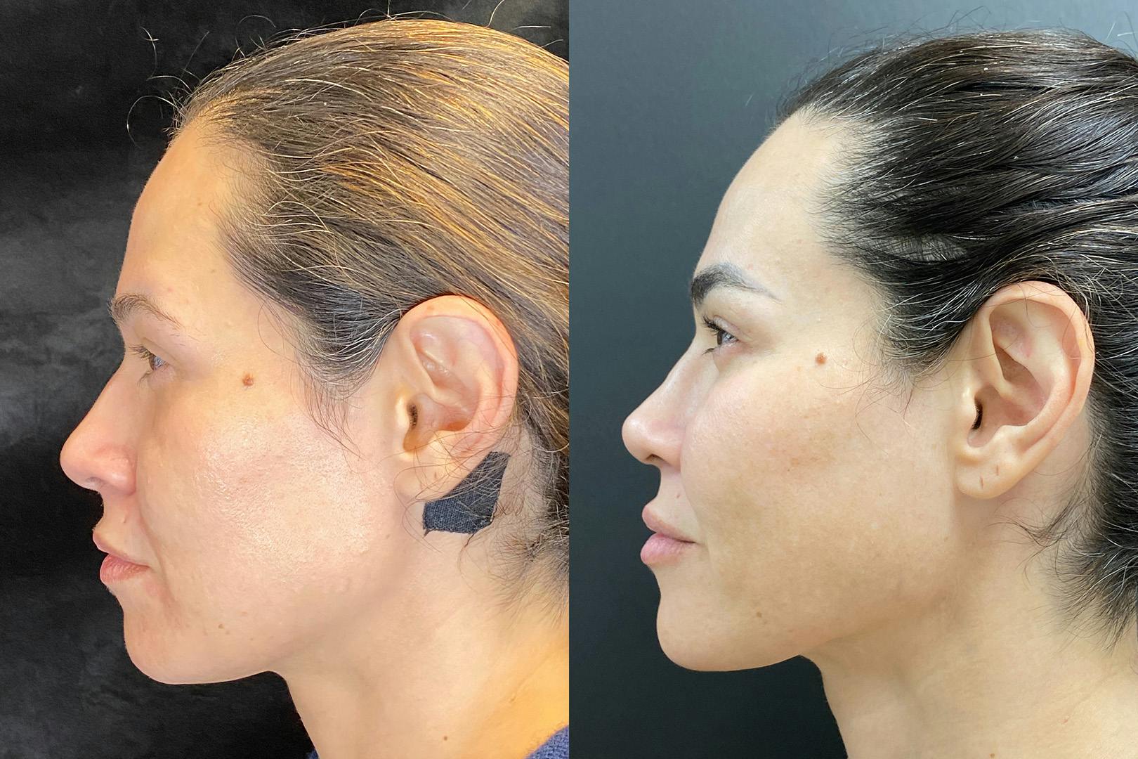 Sculptra Before & After Gallery - Patient 205396 - Image 5