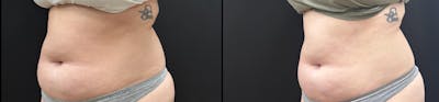EvolveX Before & After Gallery - Patient 180404 - Image 1