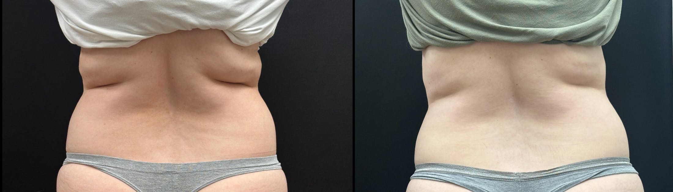 EvolveX Before & After Gallery - Patient 180404 - Image 3