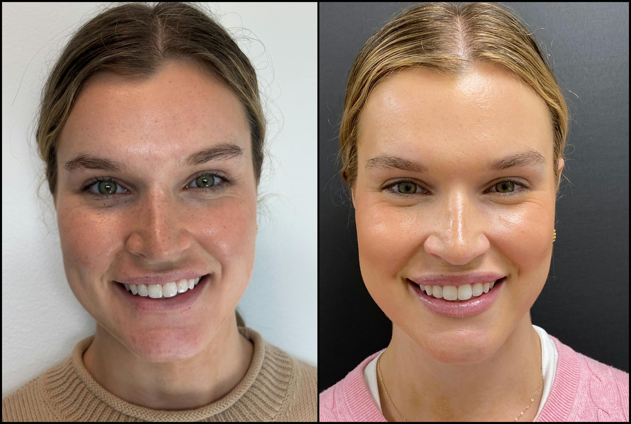 Hyaluronic Acid Injections Before & After Gallery - Patient 109210 - Image 2