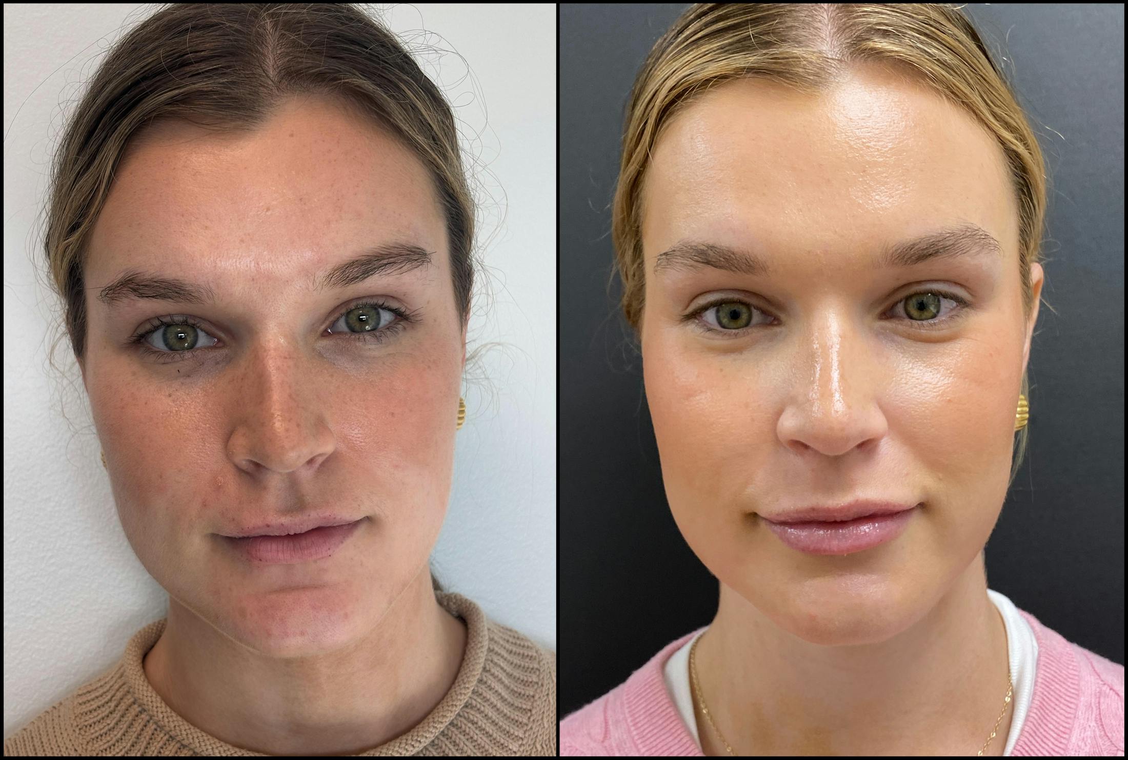 Hyaluronic Acid Injections Before & After Gallery - Patient 109210 - Image 1