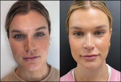 Hyaluronic Acid Injections Before & After Gallery - Patient 109210 - Image 1