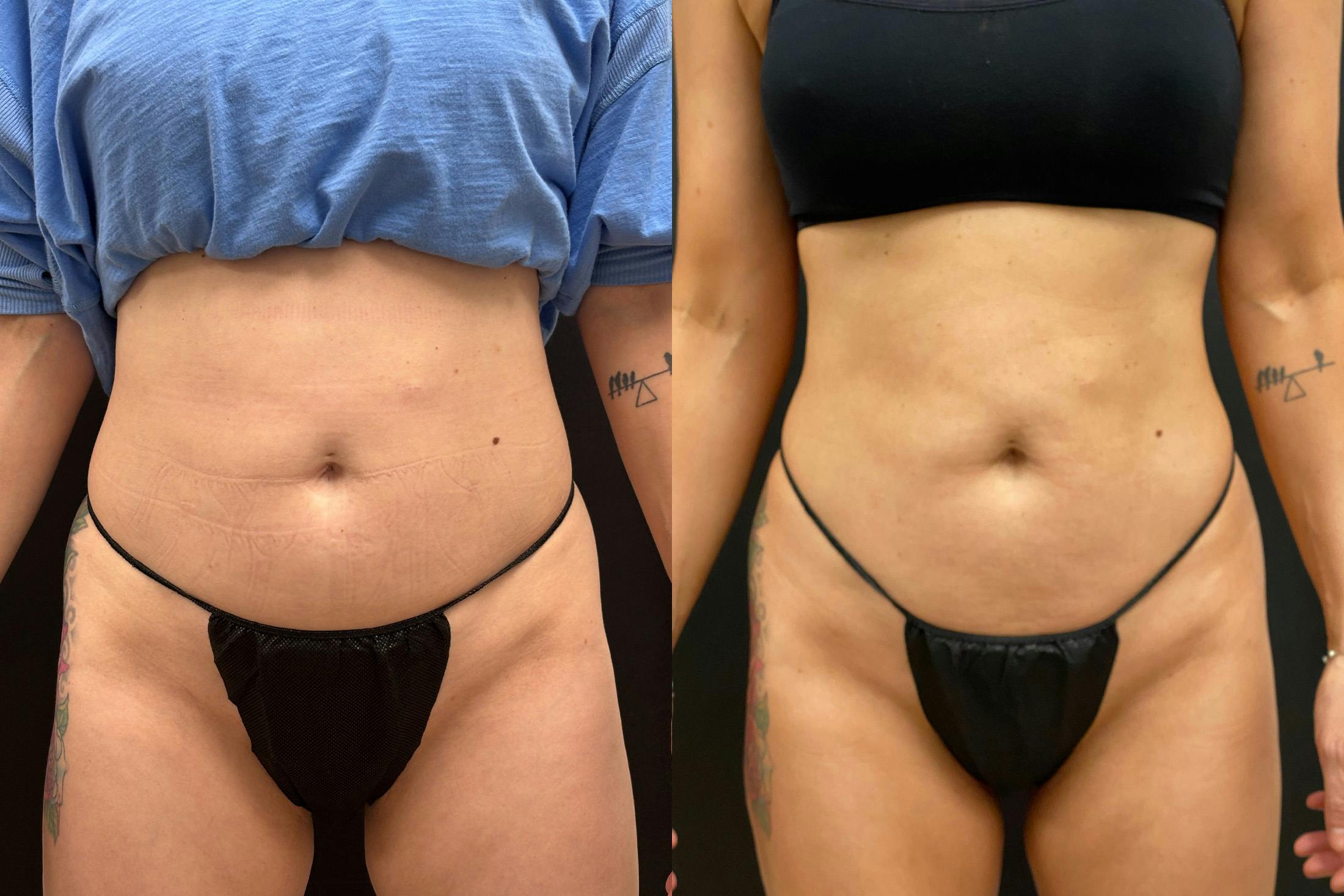 EvolveX Before & After Gallery - Patient 786884 - Image 1