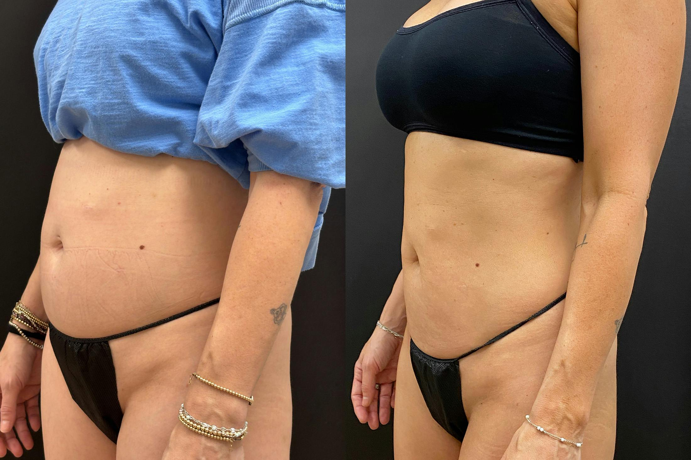 EvolveX Before & After Gallery - Patient 786884 - Image 4