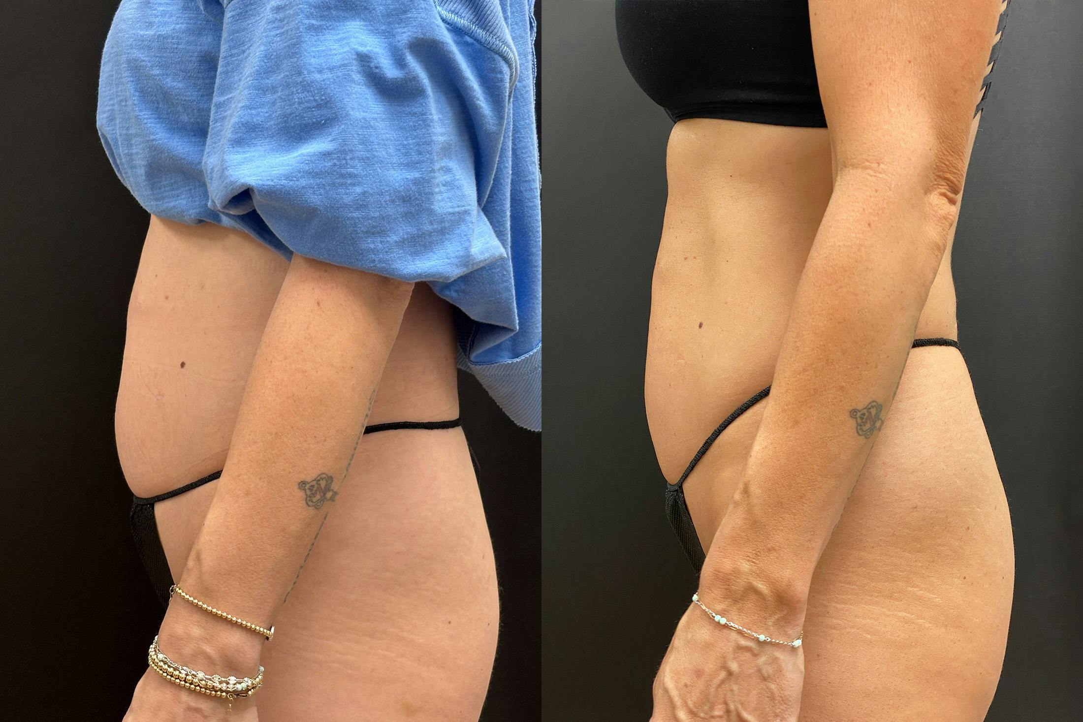 EvolveX Before & After Gallery - Patient 786884 - Image 5