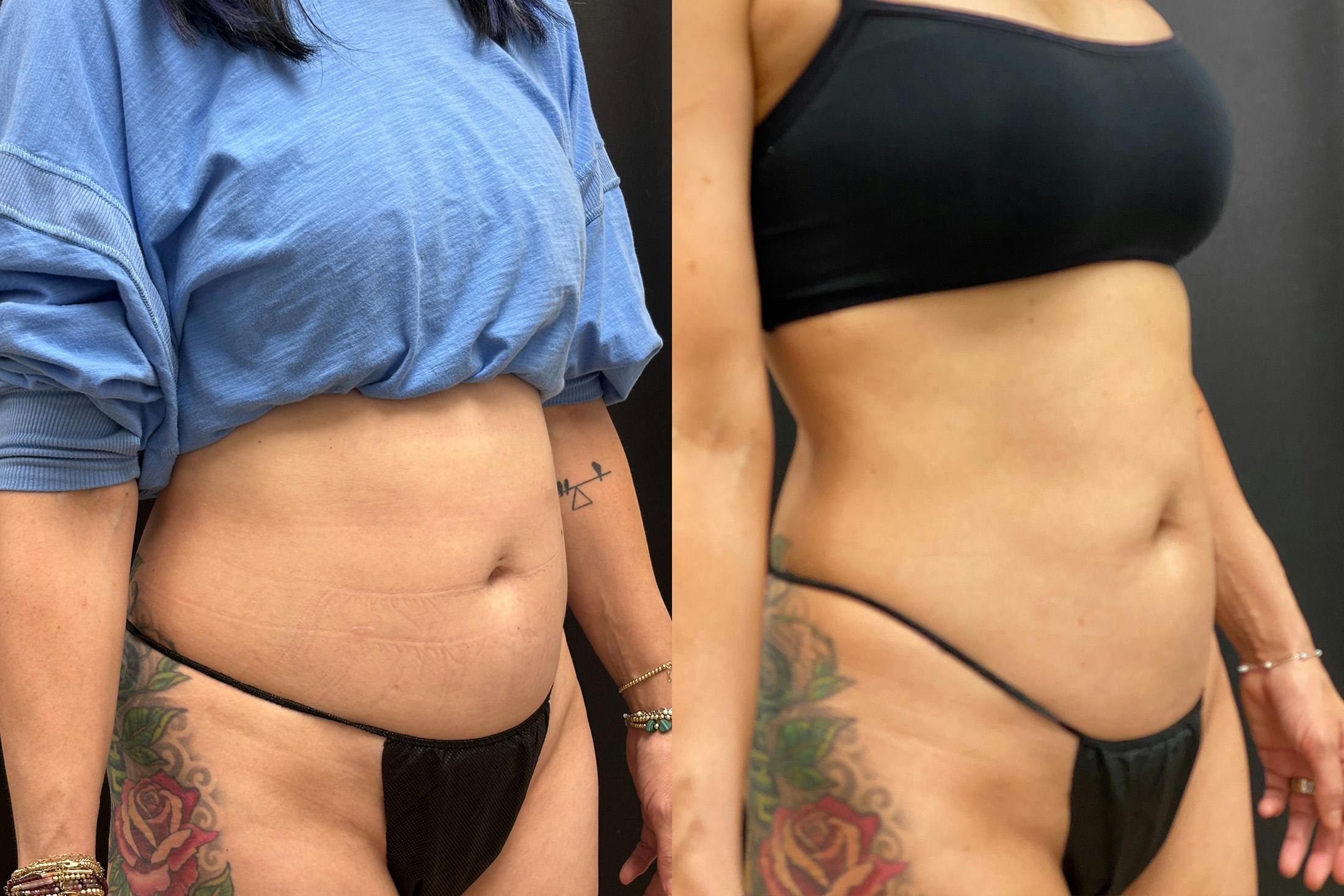 EvolveX Before & After Gallery - Patient 786884 - Image 2