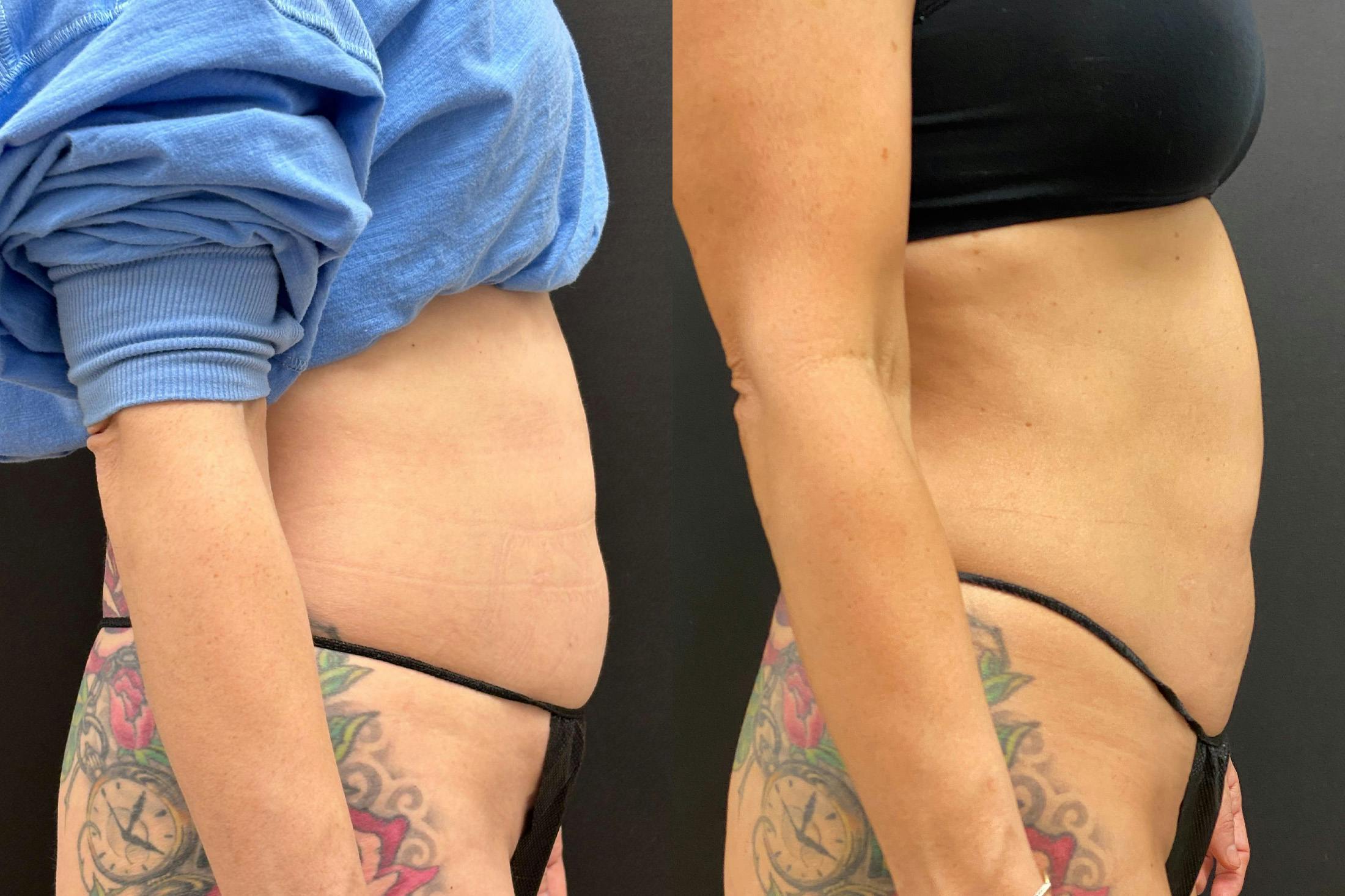 EvolveX Before & After Gallery - Patient 786884 - Image 3