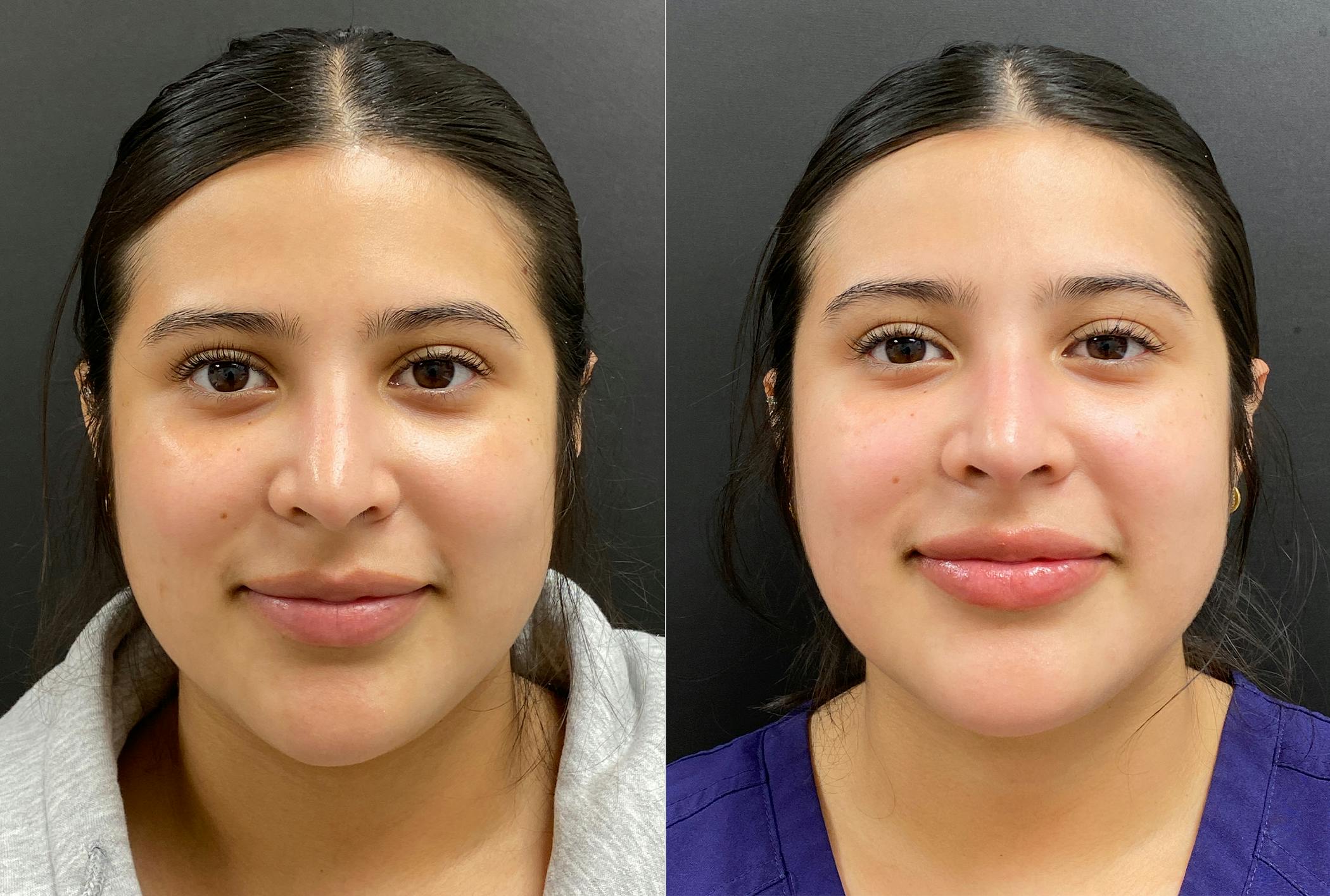Hyaluronic Acid Injections Before & After Gallery - Patient 910308 - Image 1