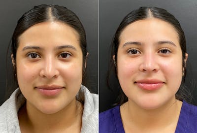 Hyaluronic Acid Injections Before & After Gallery - Patient 910308 - Image 1