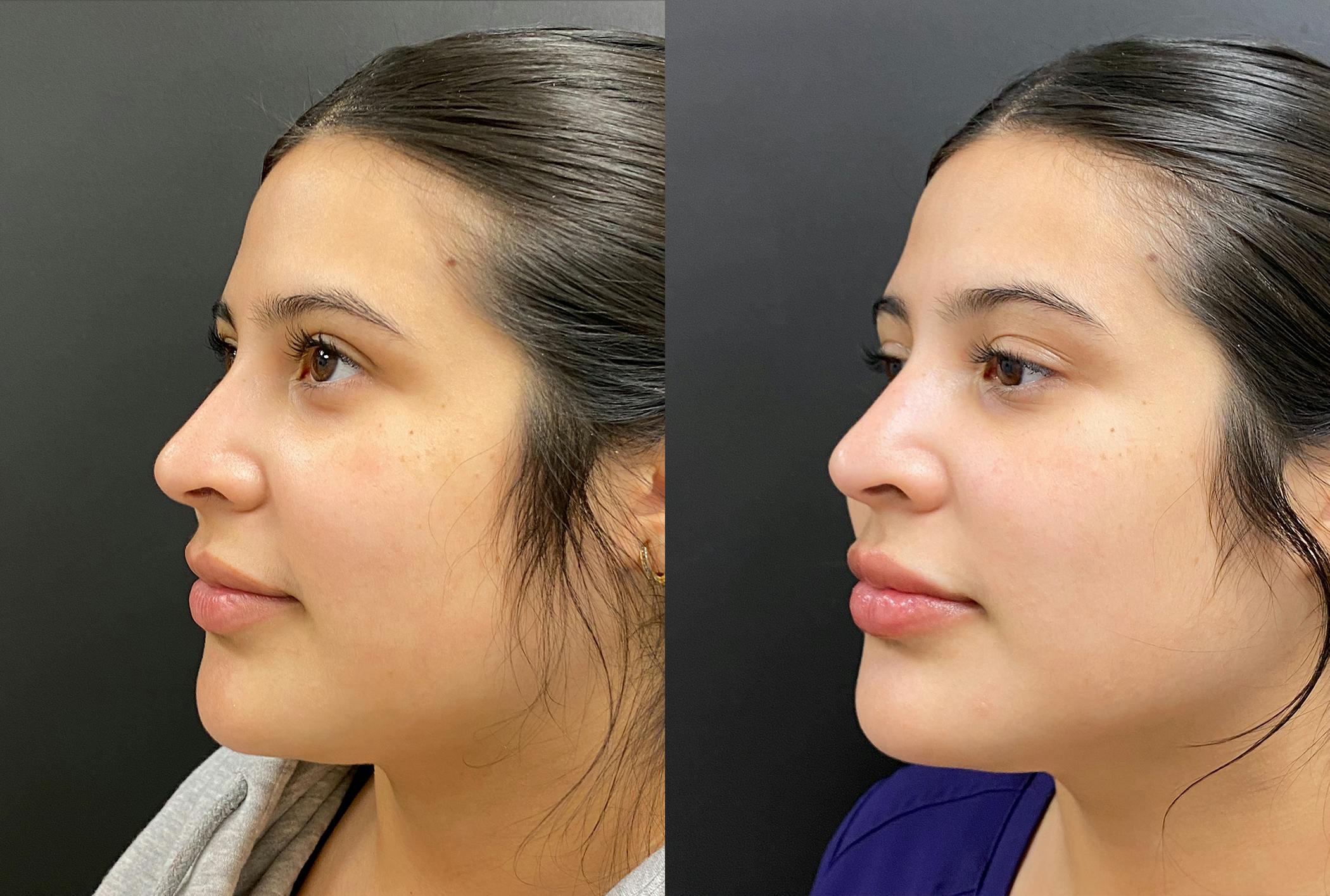 Hyaluronic Acid Injections Before & After Gallery - Patient 910308 - Image 3