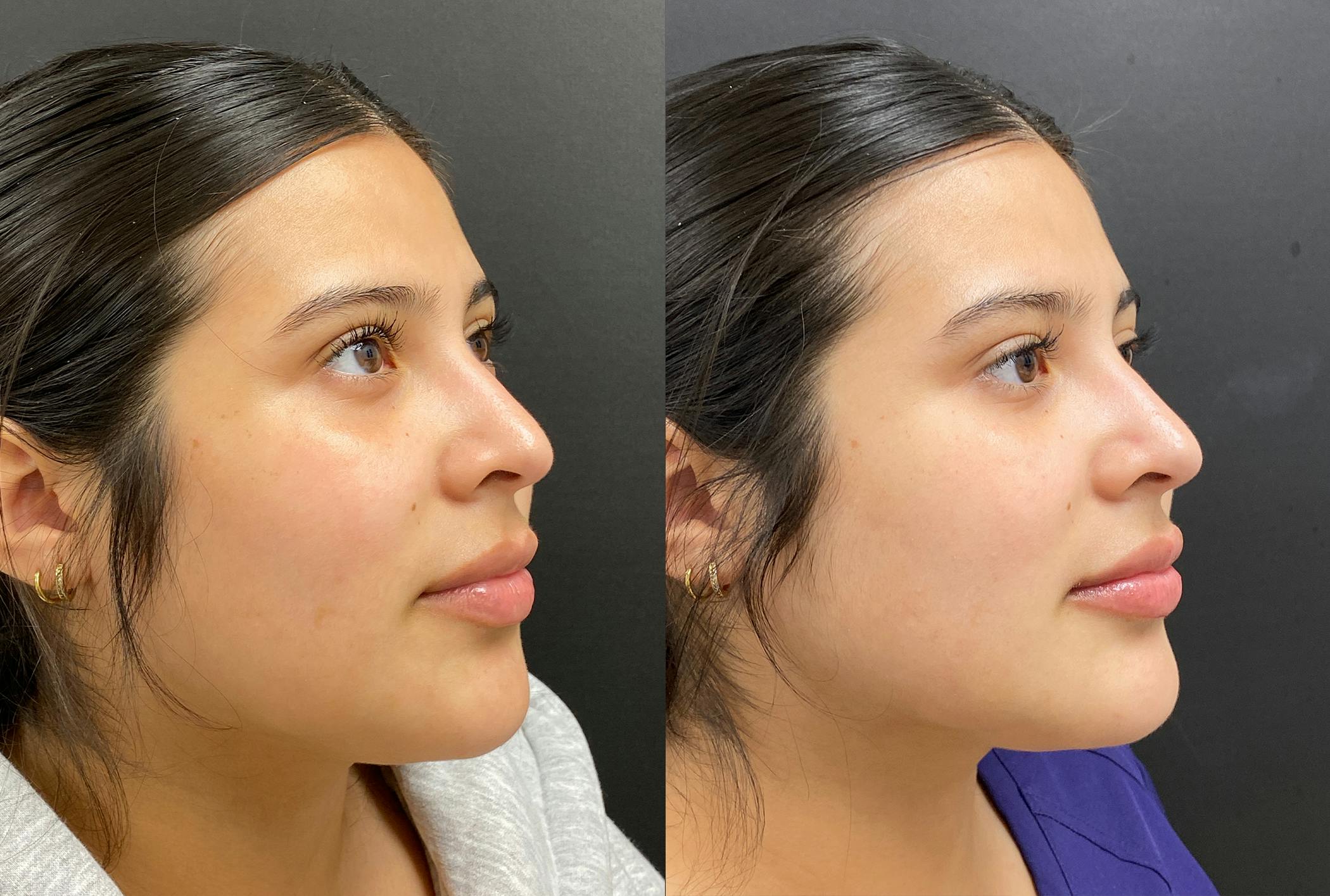 Hyaluronic Acid Injections Before & After Gallery - Patient 910308 - Image 2