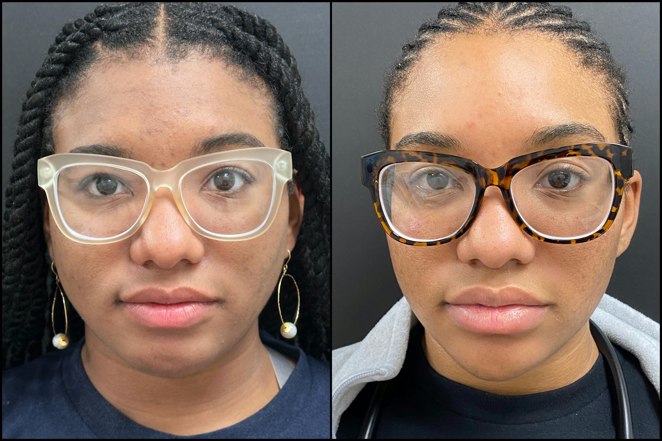 Hyaluronic Acid Injections Before & After Gallery - Patient 344819 - Image 1