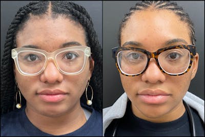 Hyaluronic Acid Injections Before & After Gallery - Patient 344819 - Image 1