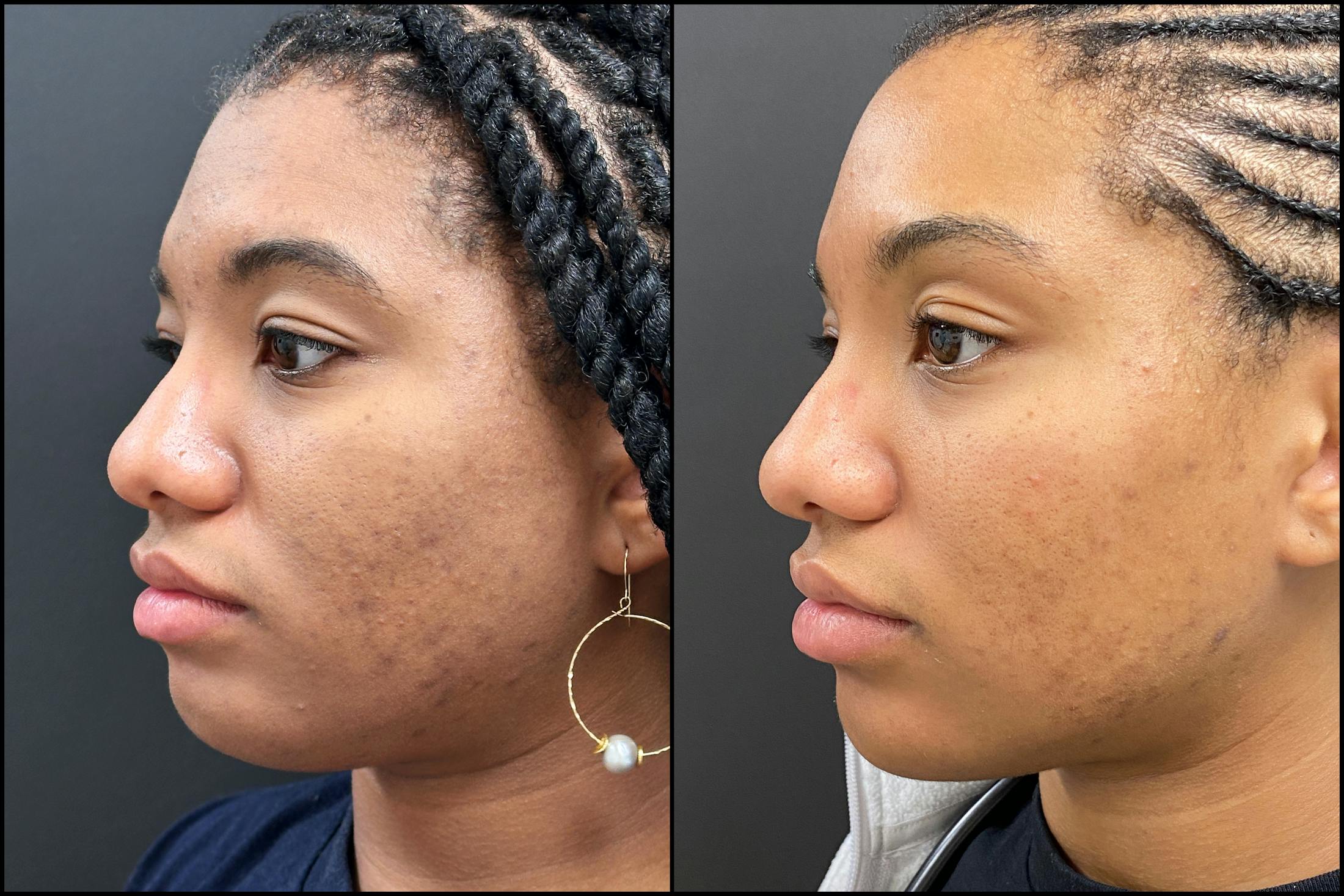 Hyaluronic Acid Injections Before & After Gallery - Patient 344819 - Image 4