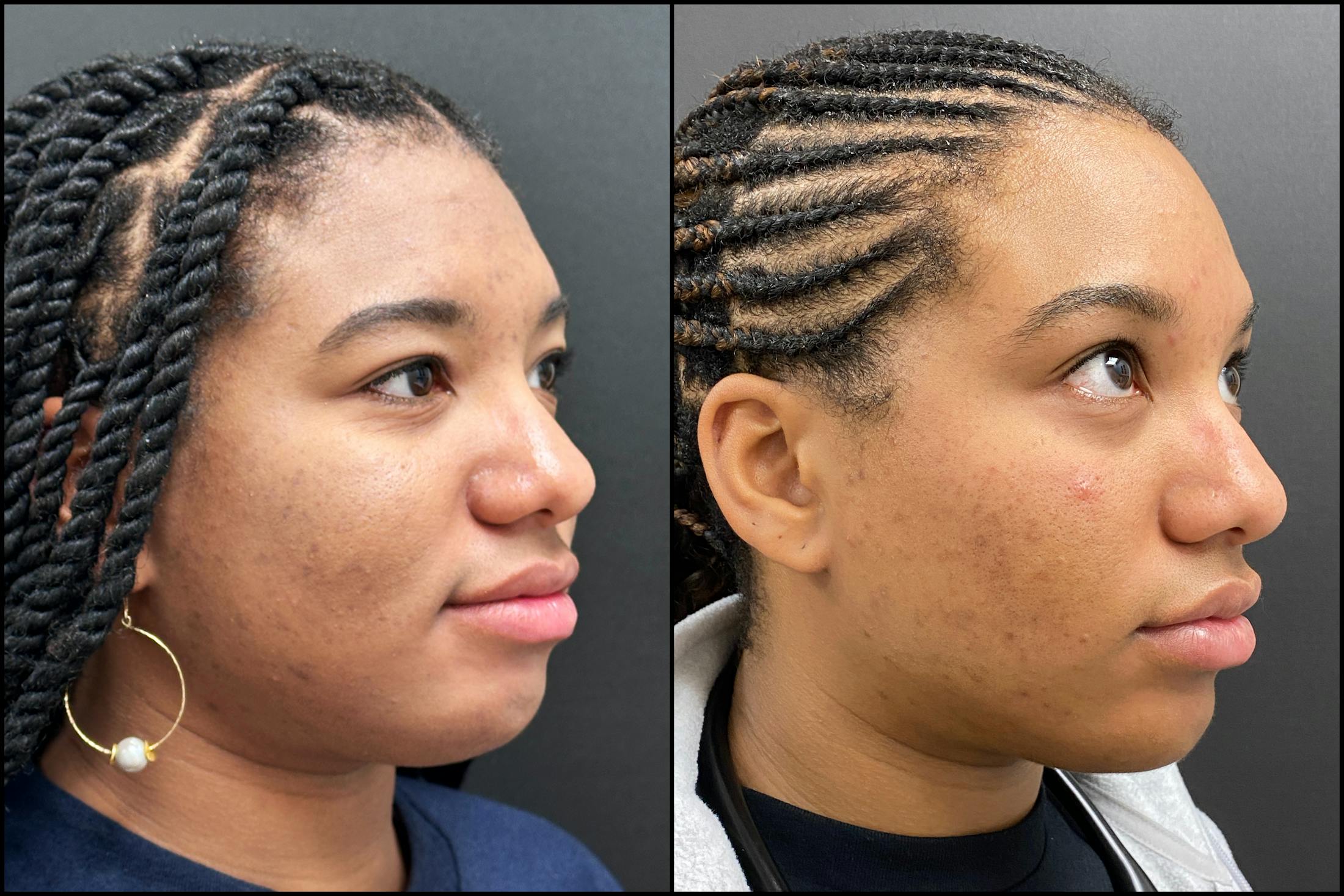 Hyaluronic Acid Injections Before & After Gallery - Patient 344819 - Image 2