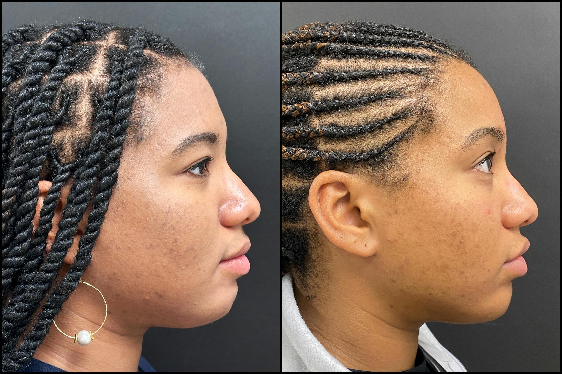 Hyaluronic Acid Injections Before & After Gallery - Patient 344819 - Image 3