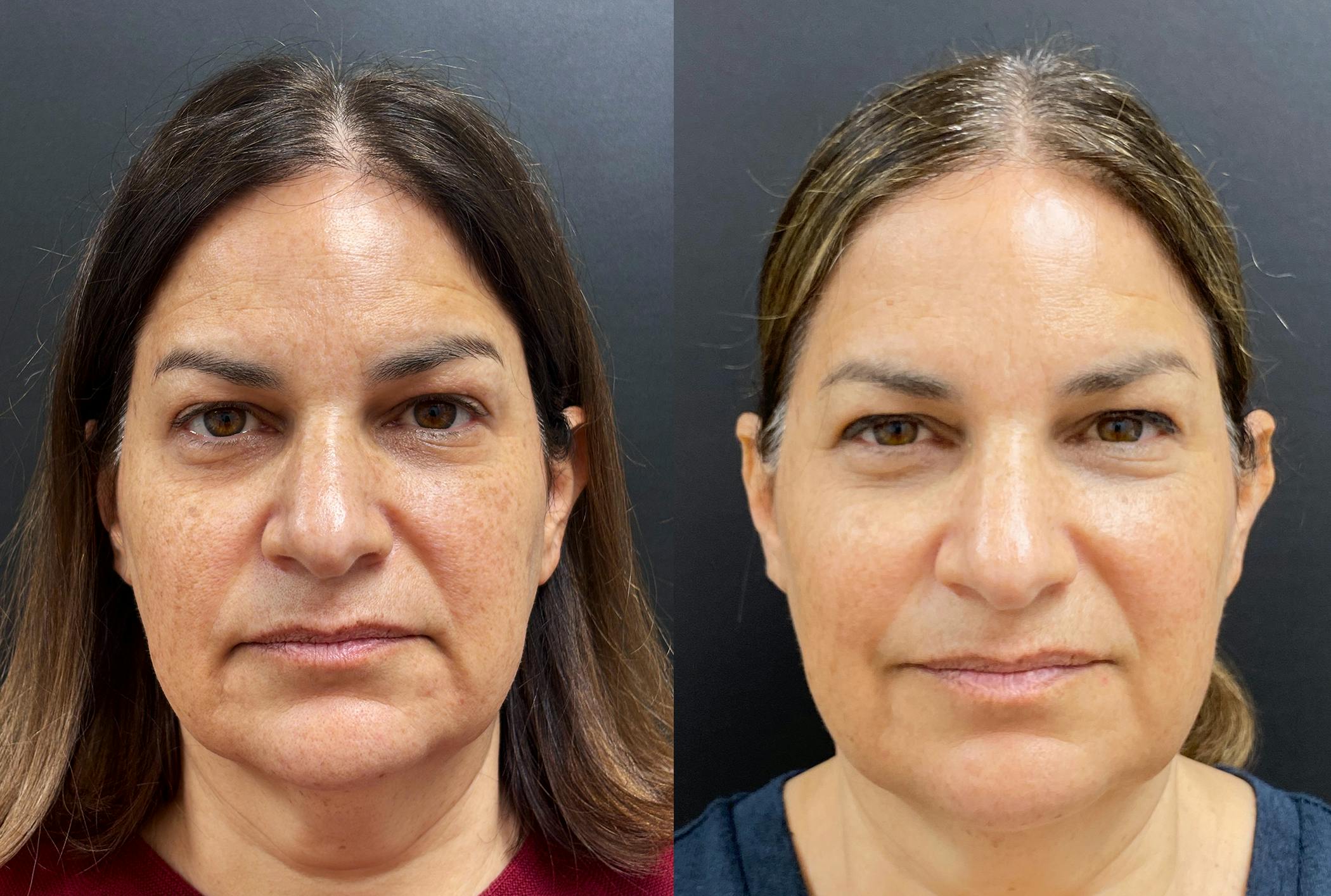 Sculptra Before & After Gallery - Patient 429608 - Image 1