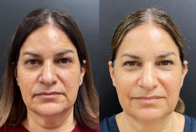 Sculptra Before & After Gallery - Patient 429608 - Image 1