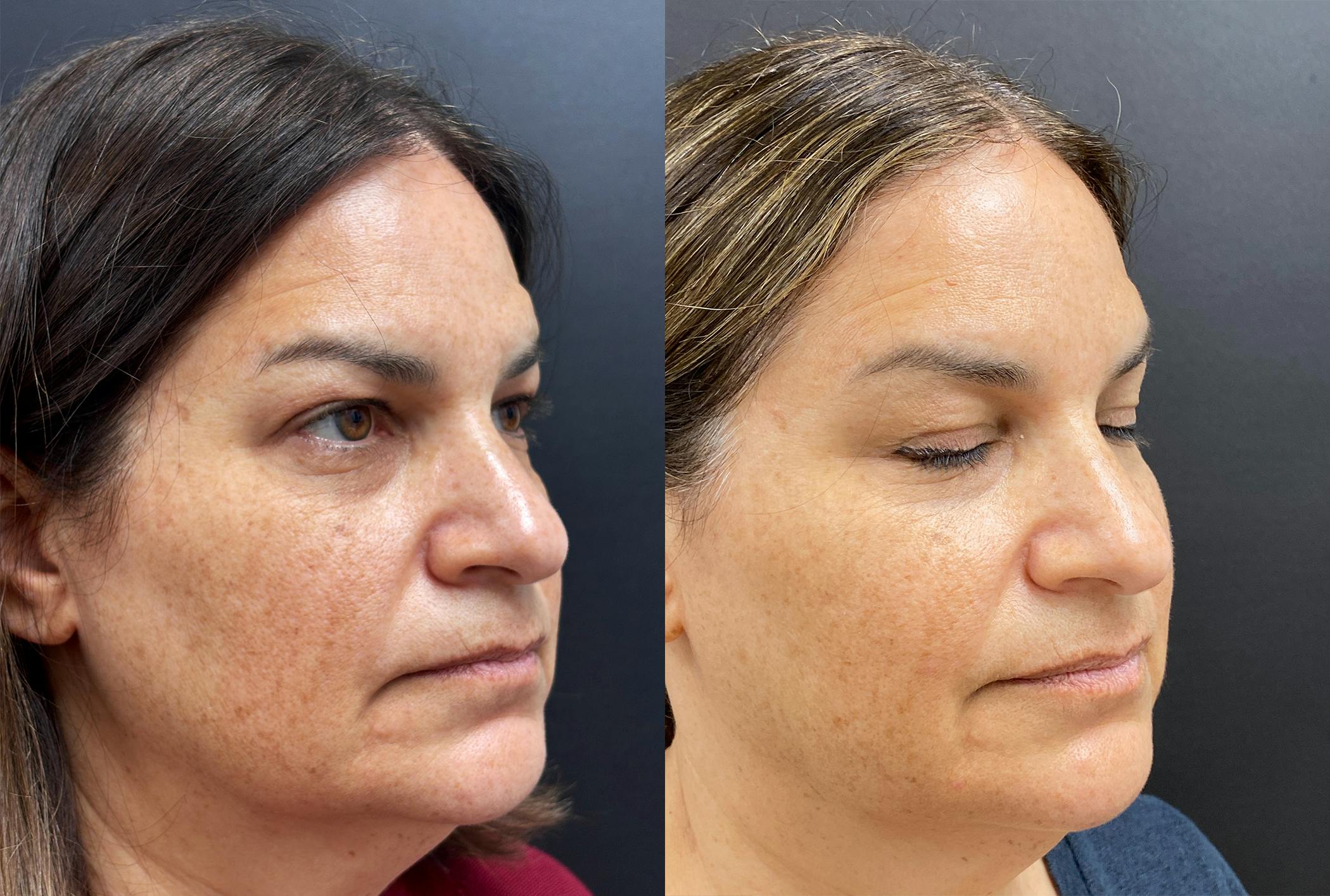 Sculptra Before & After Gallery - Patient 429608 - Image 2