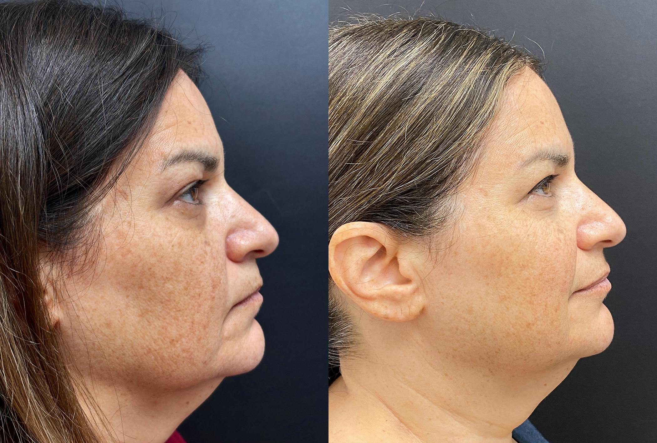 Sculptra Before & After Gallery - Patient 429608 - Image 3