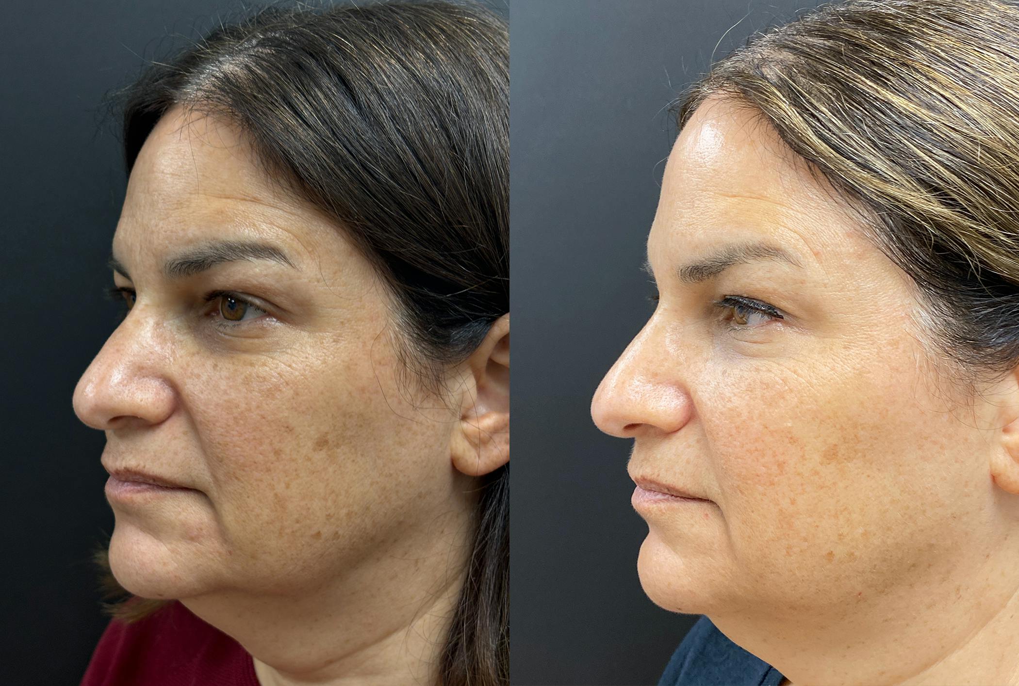Sculptra Before & After Gallery - Patient 429608 - Image 4