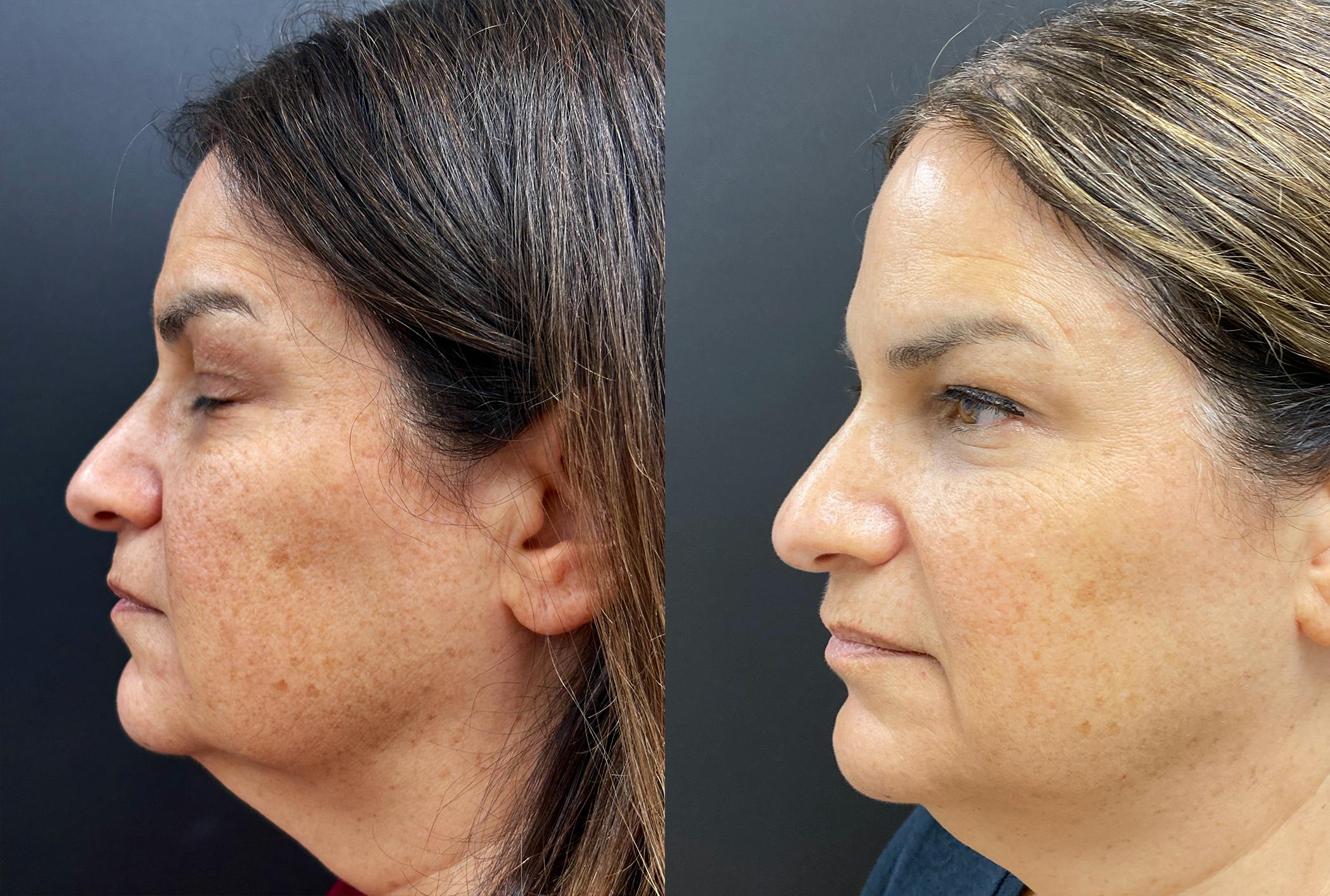 Sculptra Before & After Gallery - Patient 429608 - Image 5