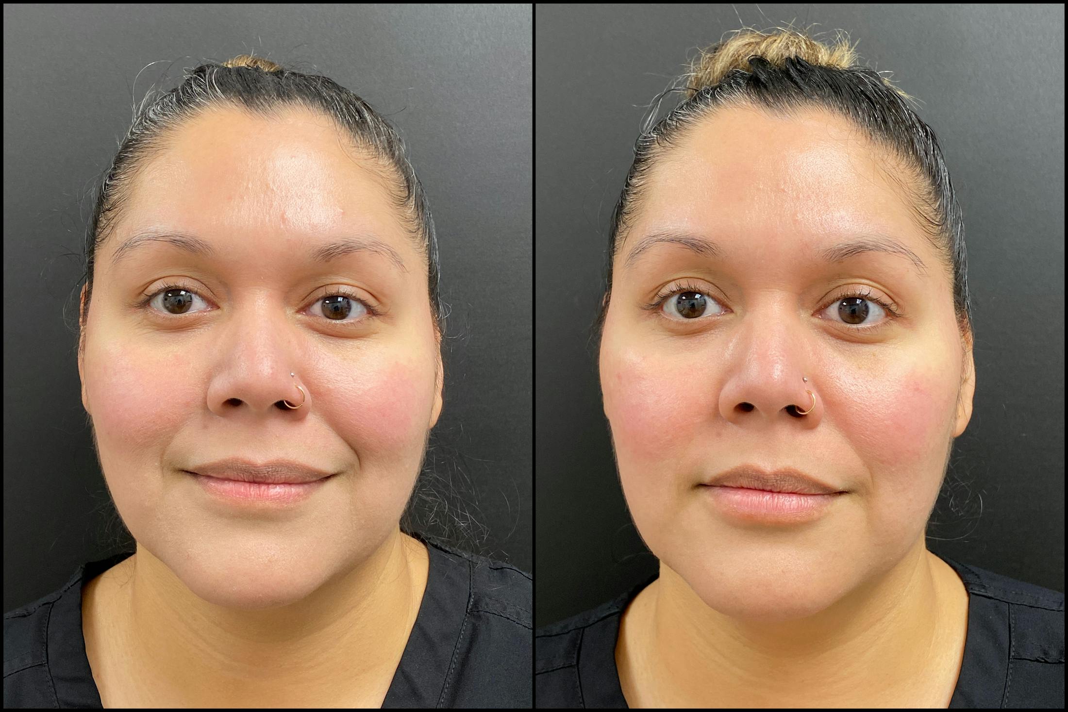 Hyaluronic Acid Injections Before & After Gallery - Patient 247874 - Image 1