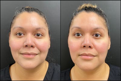 Hyaluronic Acid Injections Before & After Gallery - Patient 247874 - Image 1