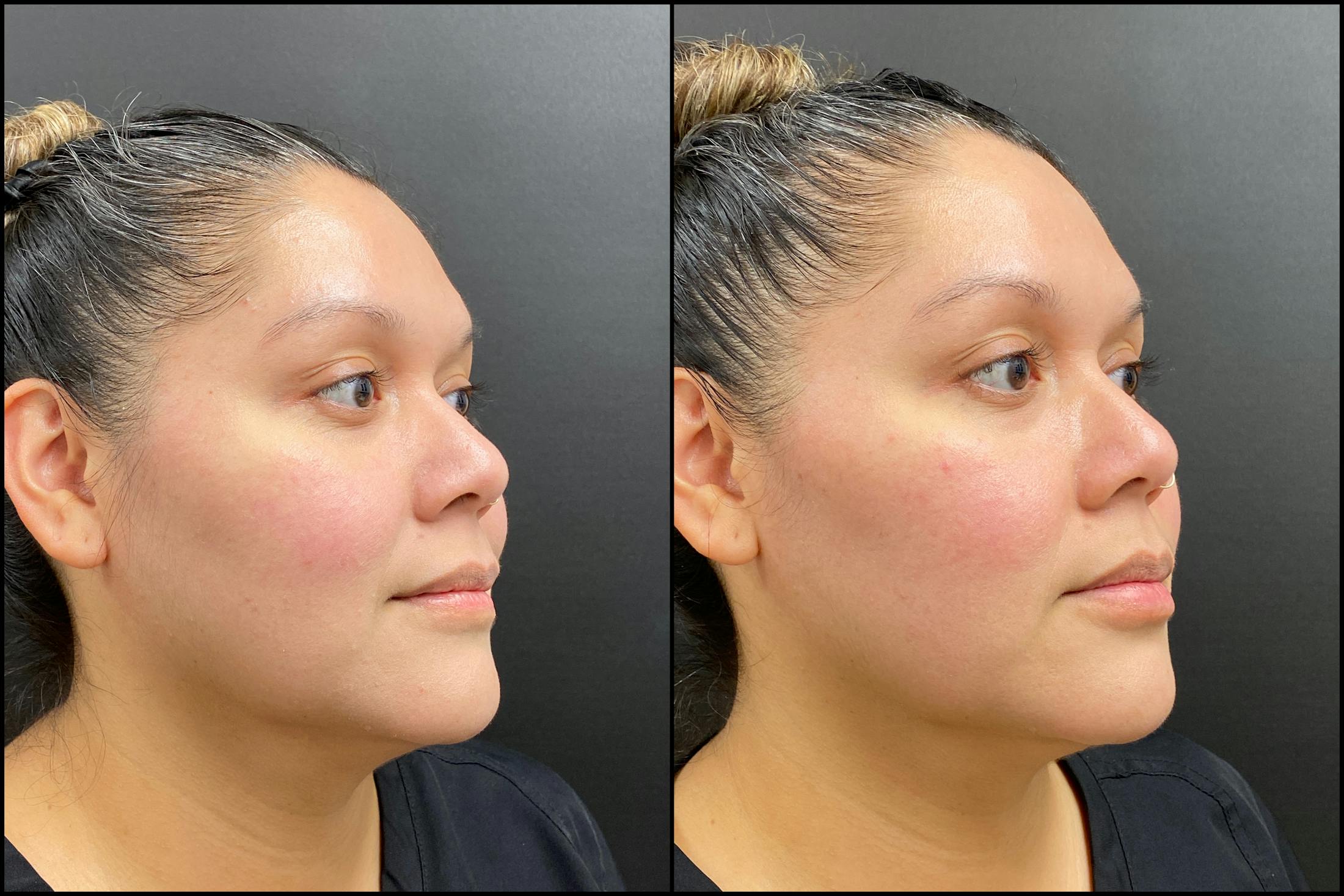 Hyaluronic Acid Injections Before & After Gallery - Patient 247874 - Image 2